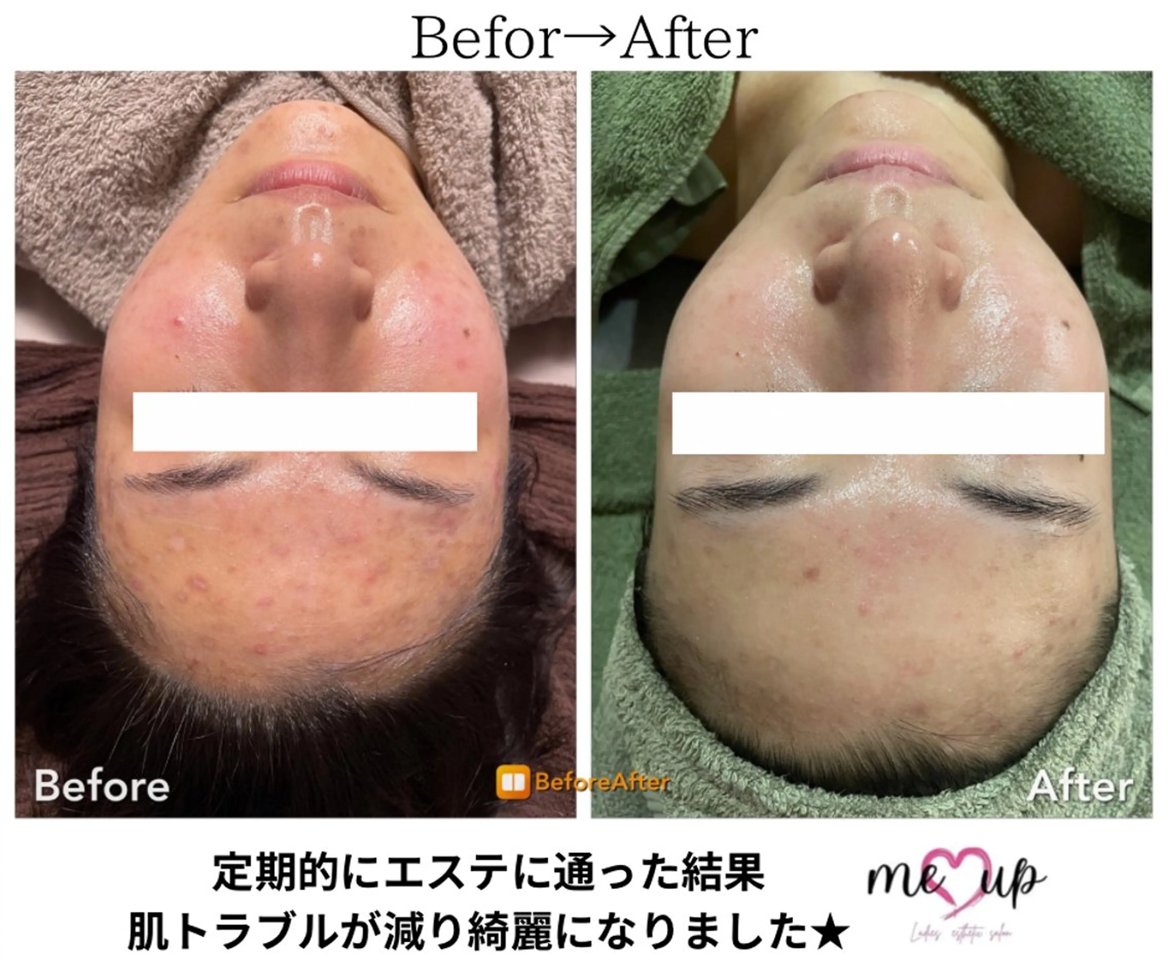 Meupニキビ専門店 背中/ハーブ/肌管理のその他イメージ