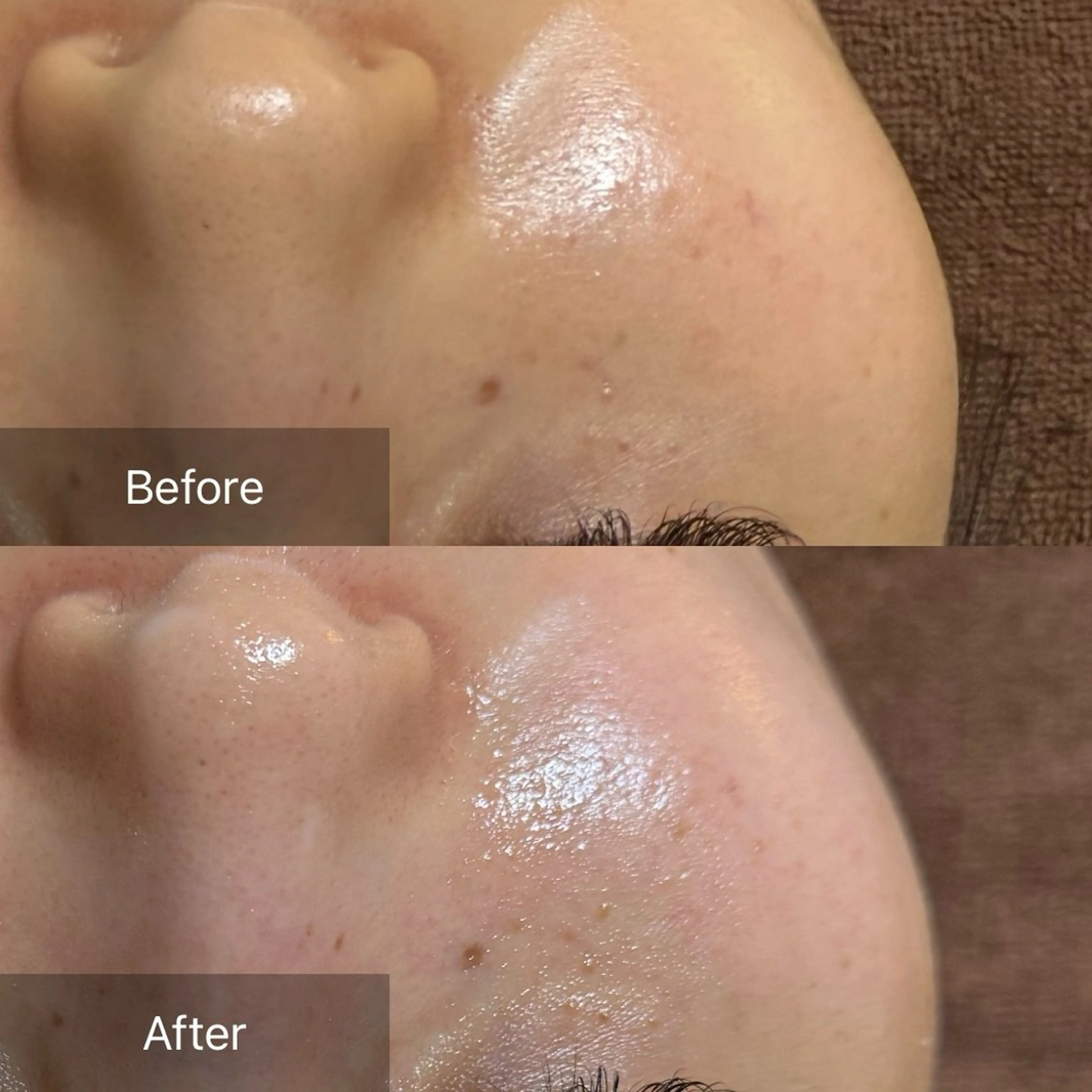 【初回】毛穴と肌の底上げケア《esV10》の写真