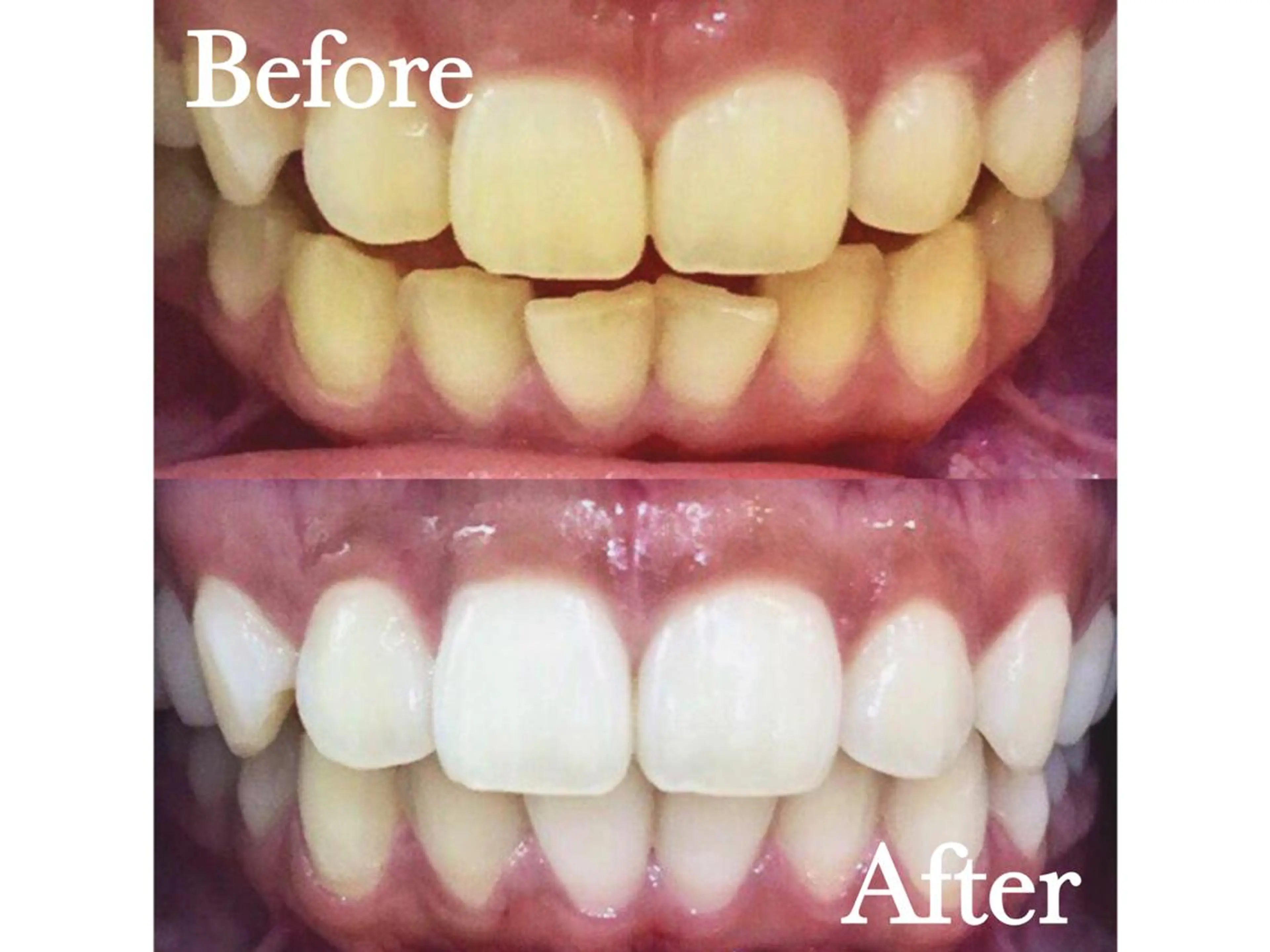 【先着‼️100名様限定👑】セルフホワイトニングハイパワー5分照射🦷定額プラン💎の写真