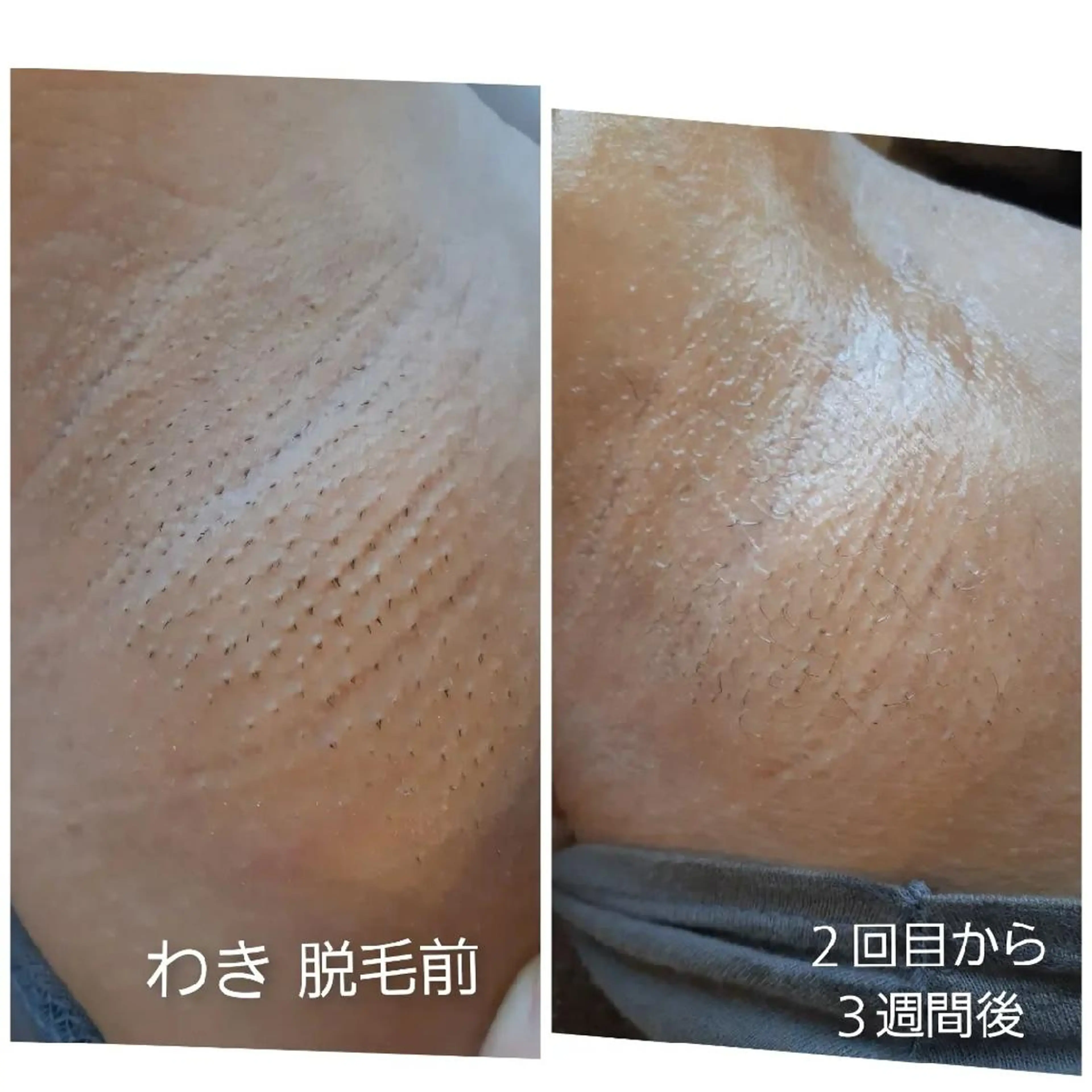 ワキ脱毛　美肌光脱毛の写真
