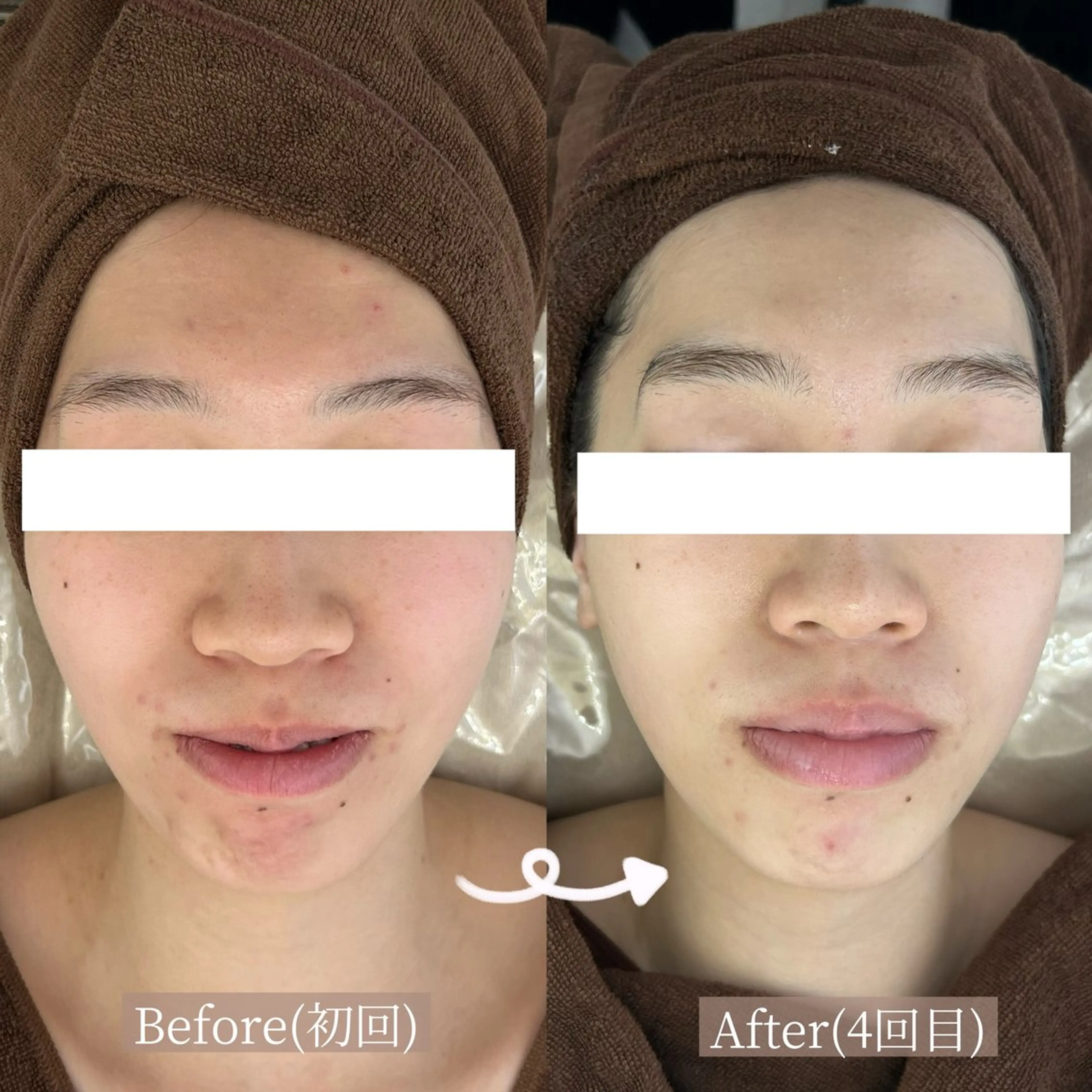 エステ リラク 毛穴・ニキビケア　ハーブピーリング【肌管理専門店】WHITE AQUA鳳店所属・ホワイトアクア 鳳店のエステ・リラクイメージ