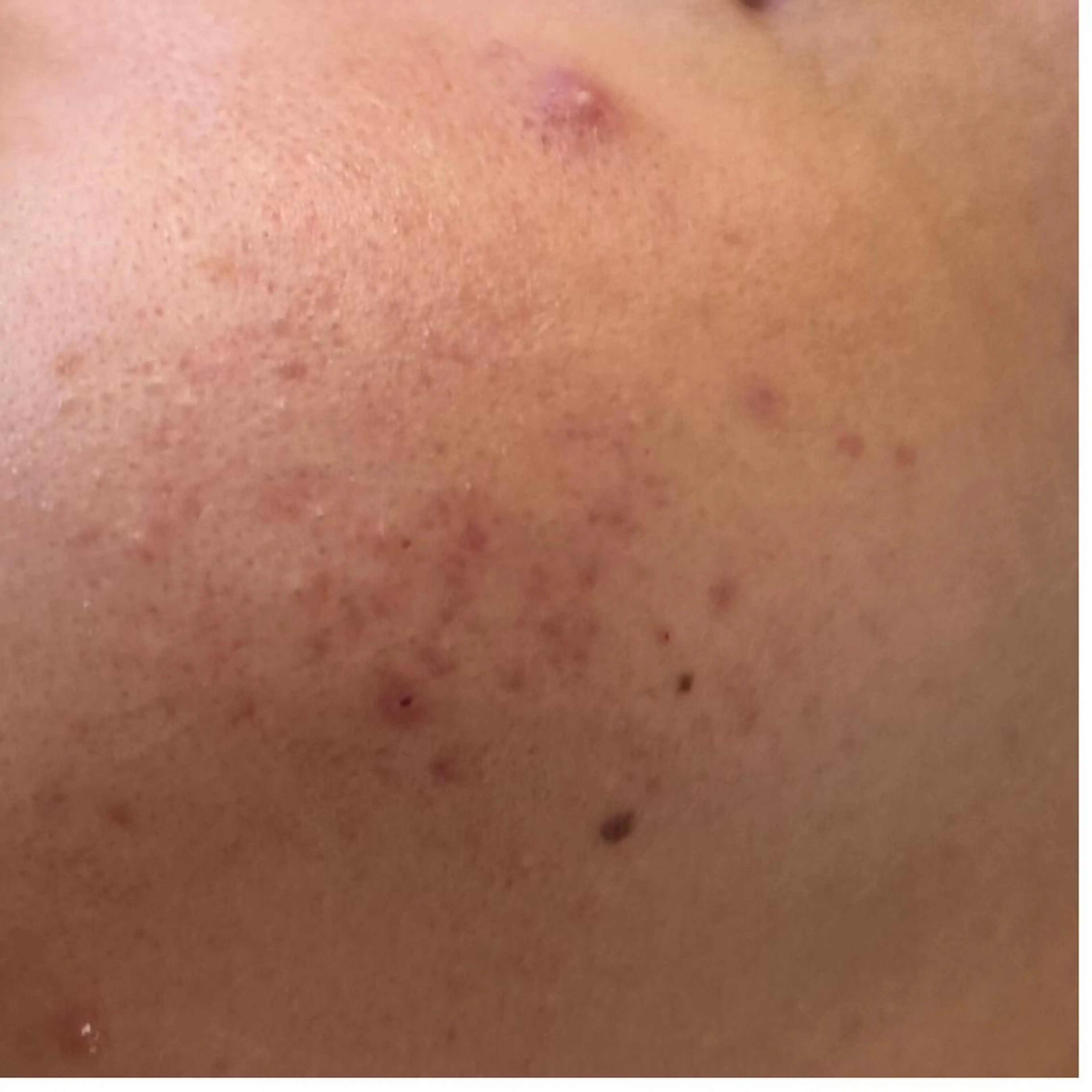 【頑固なニキビにお悩みの方へ】プラズマによる滅菌・肌再生ケアの写真