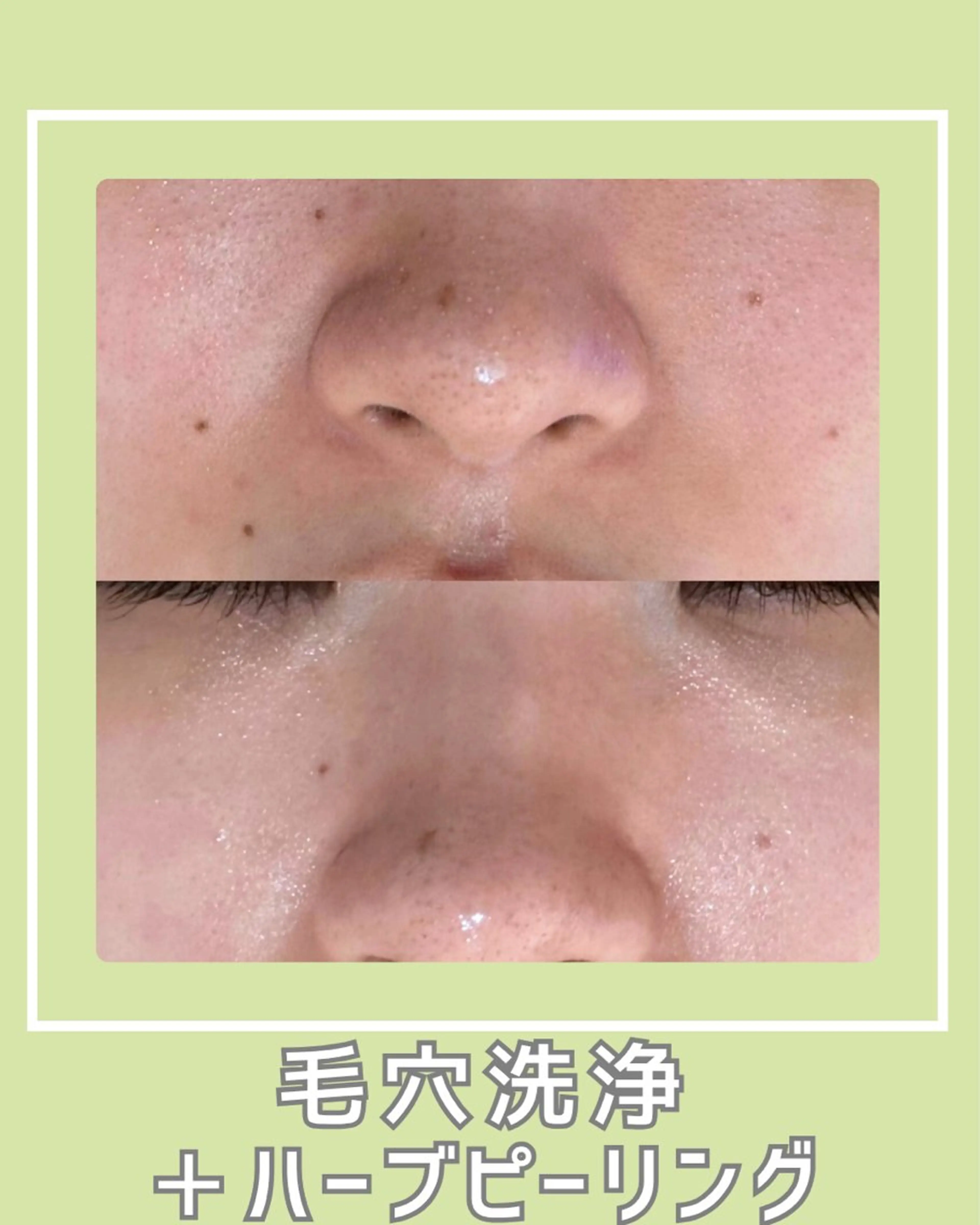 エステ |ピーリング・毛穴| soina神楽坂のエステ・リラクイメージ