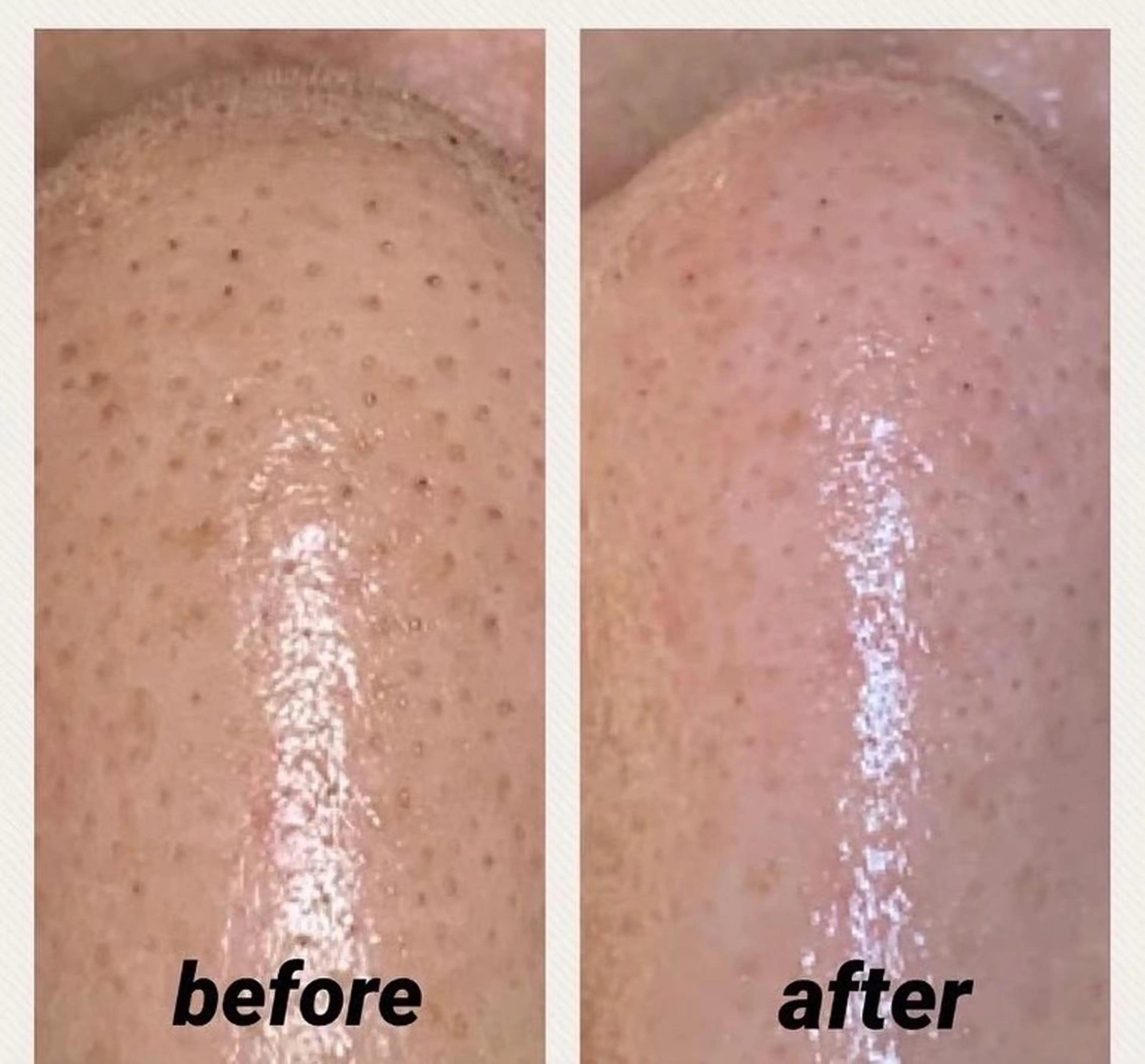 角栓・黒ずみ・いちご鼻【ヨーロッパ式毛穴洗浄】毛穴エクストラクション+毛穴縮小ケア　16500円→初回13500円の写真