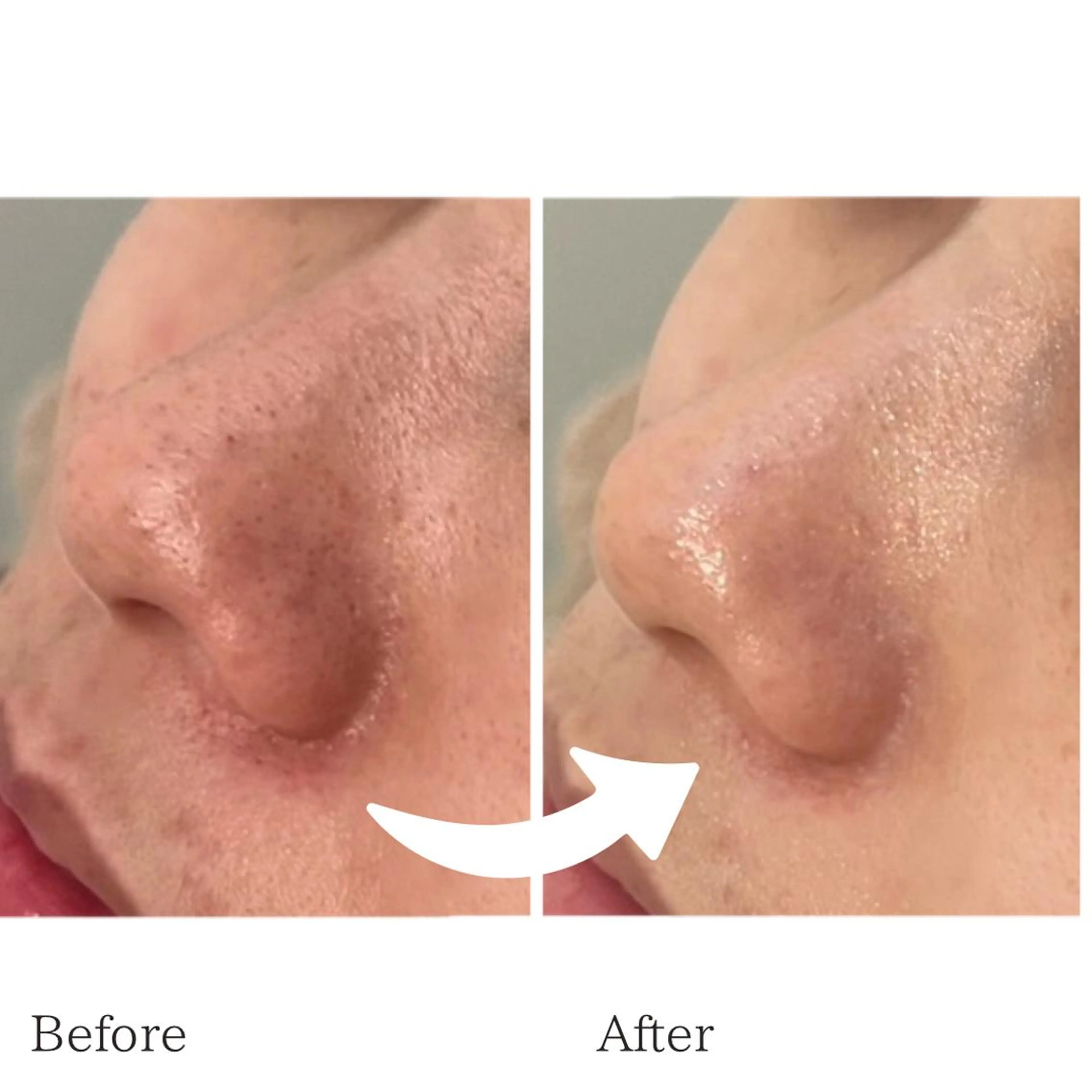 【モニター大募集❣️期間限定】さよなら毛穴ちゃん👋💕毛穴黒ずみケア＆肌悩み別パック👧✨の写真