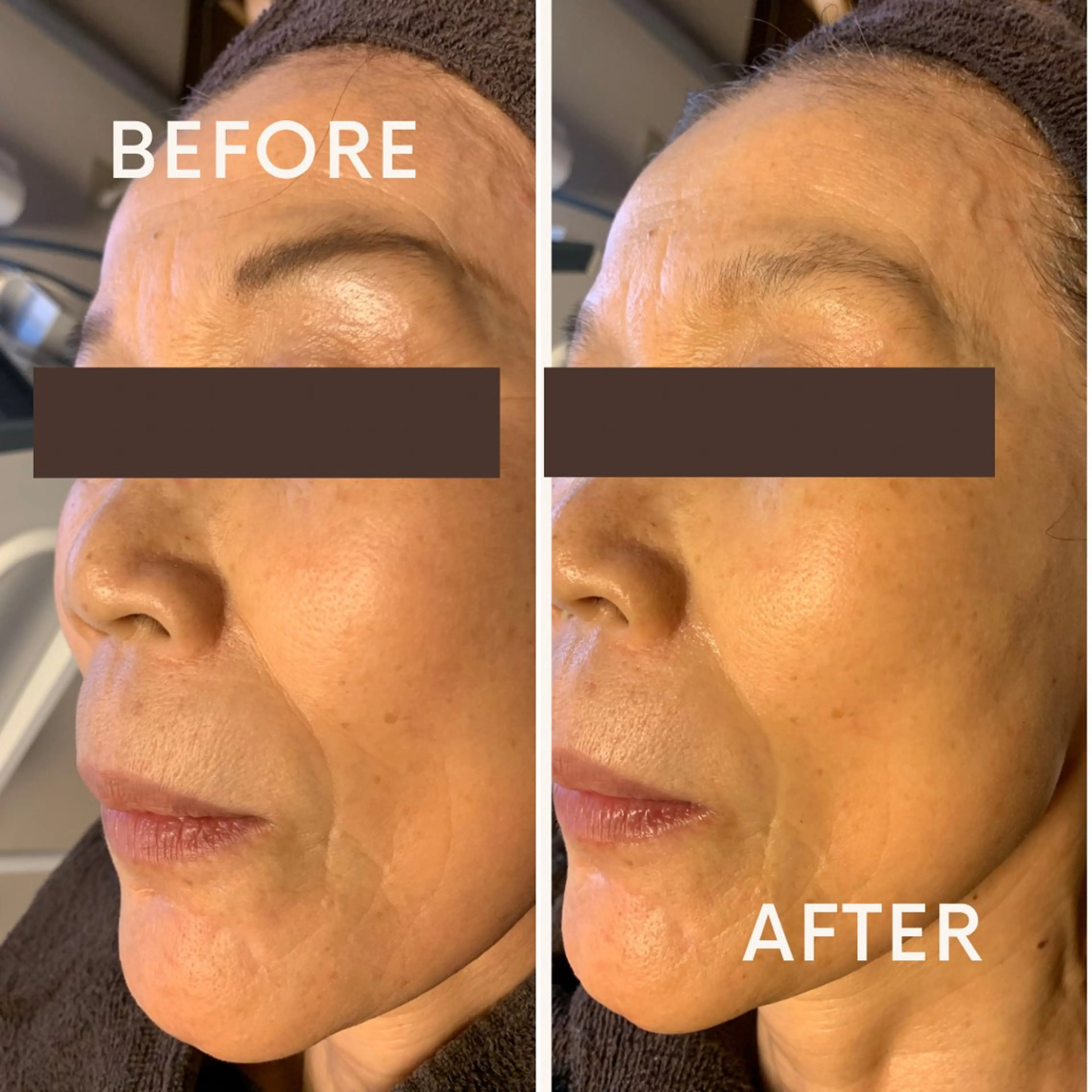 くすみ・透明感UPエステの写真