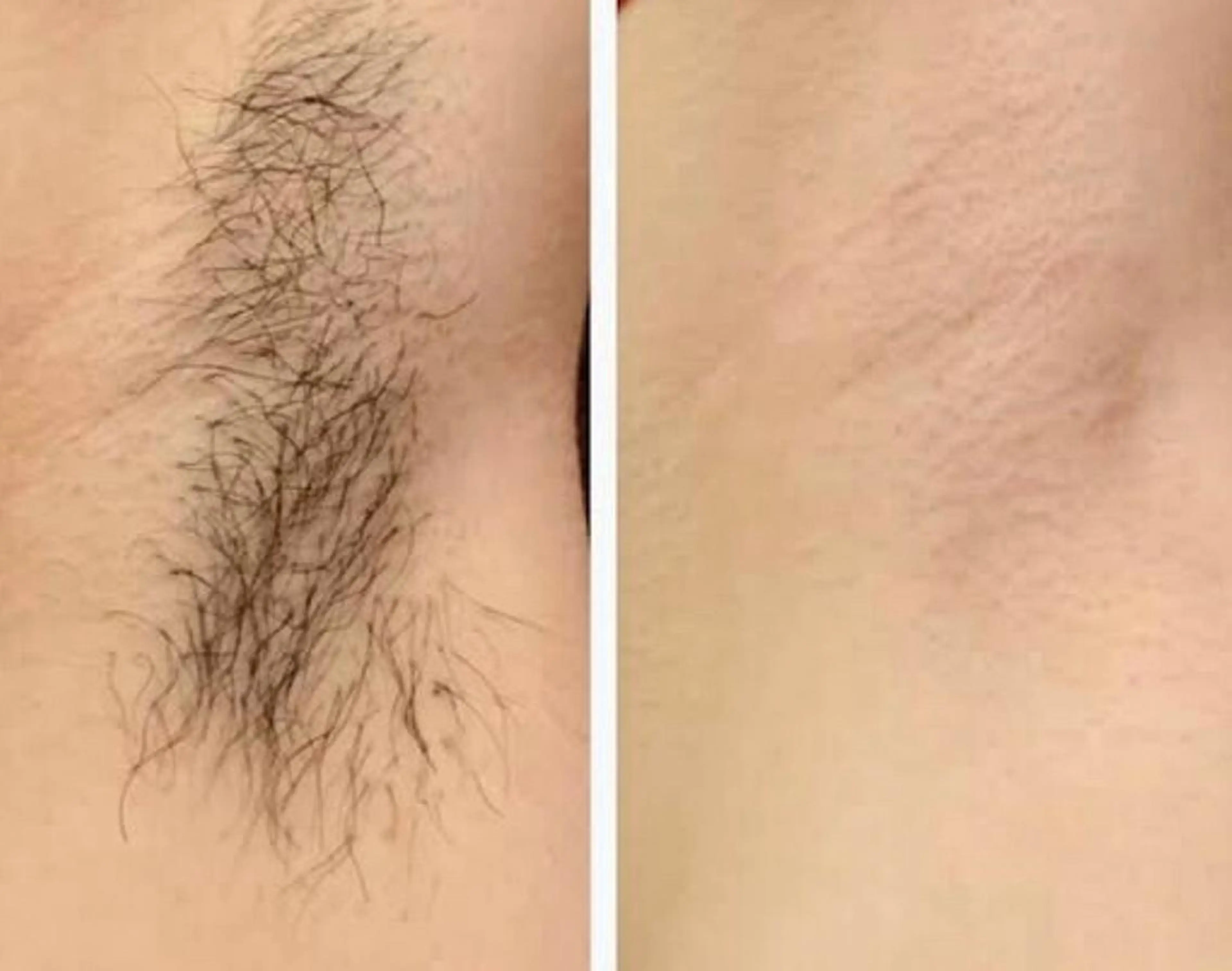 脱毛 Bell Tree すずきのエステ・リラクイメージ