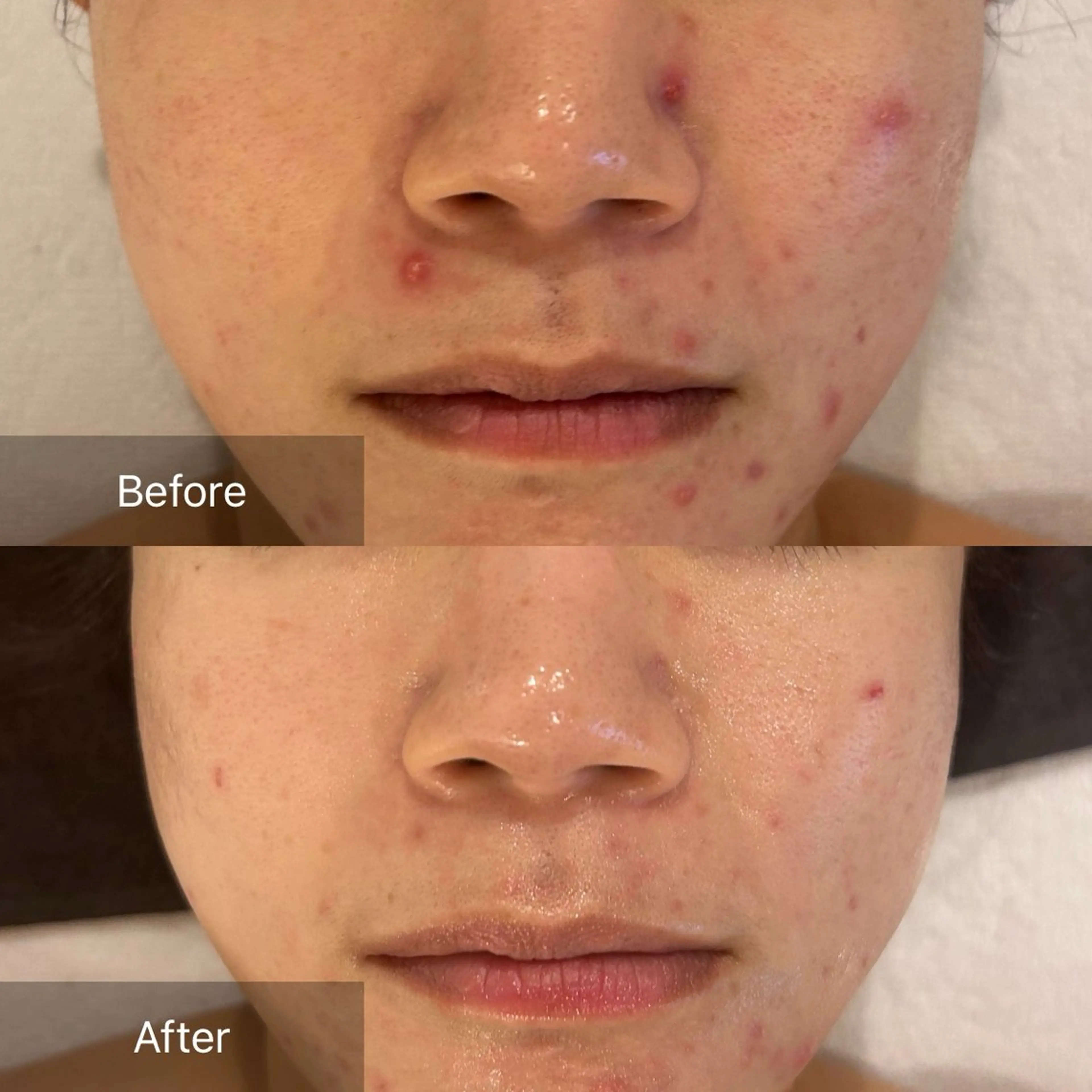 今の肌に足りないものを土台作り！オーダーメイド【トロイアルケ韓国肌管理】LDM＋LED込の写真