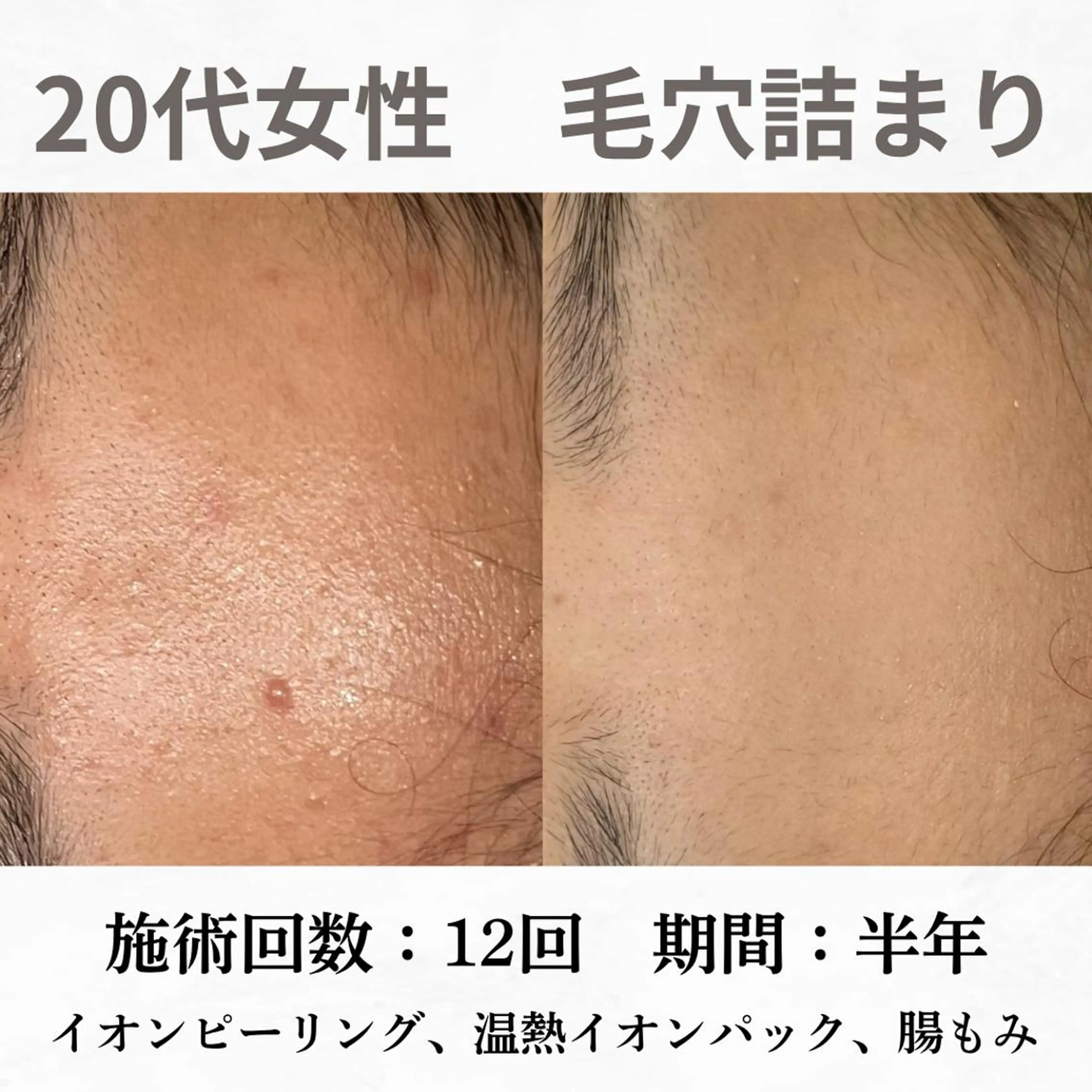 重度ニキビ専門🌷 ダウンタイムなしのエステ・リラクイメージ