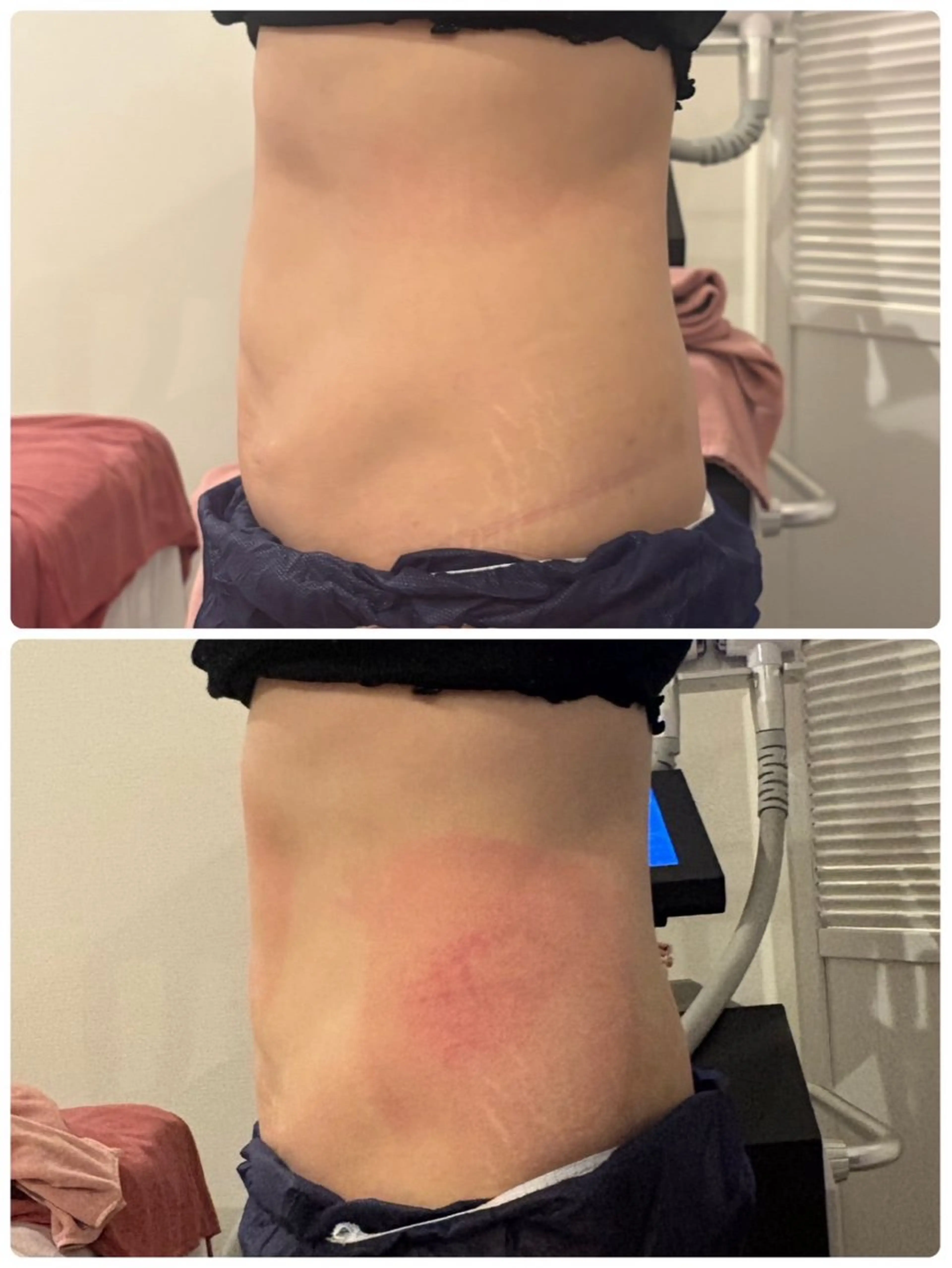 冷却スリミングケア4部位の写真