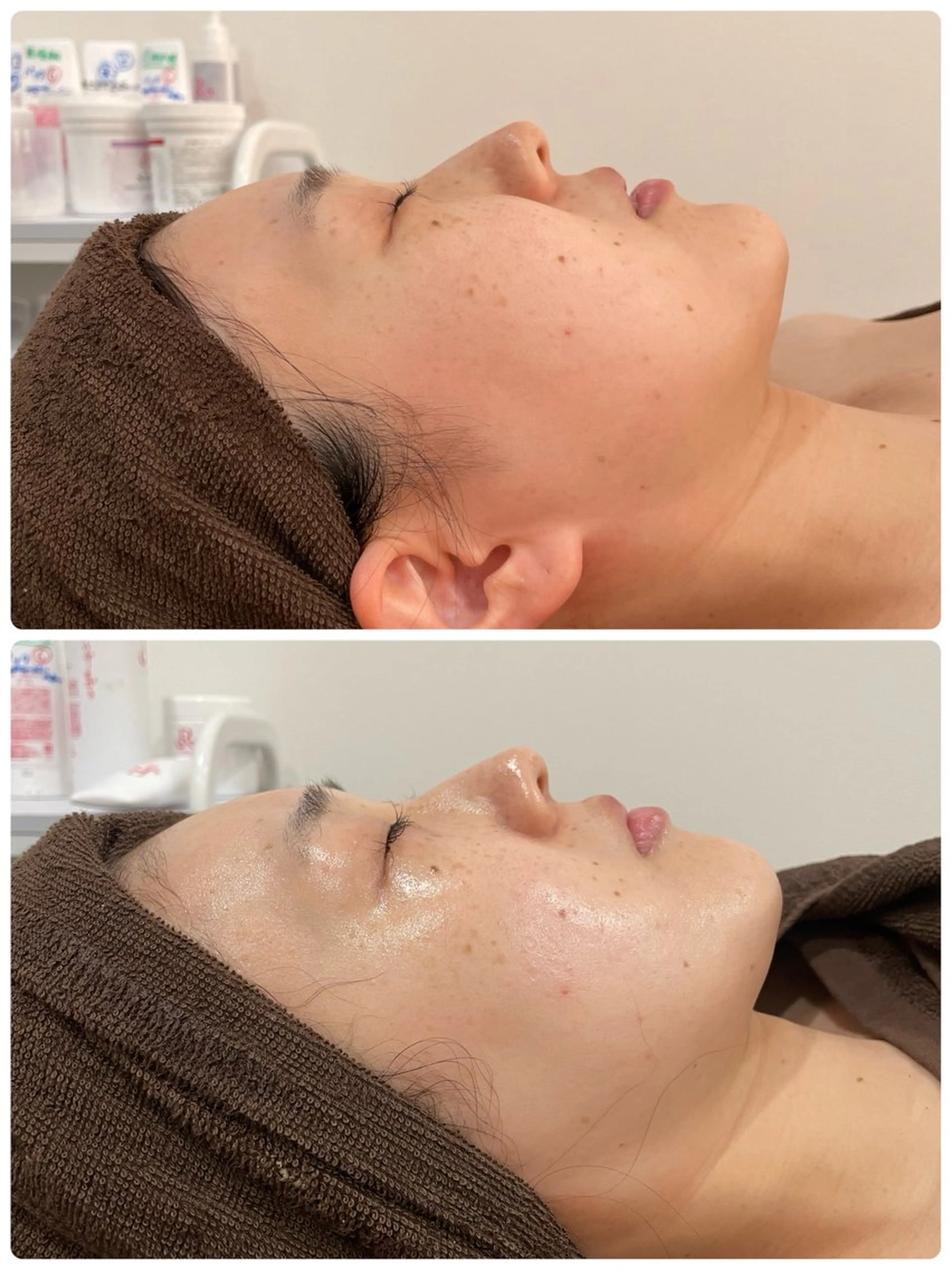 キメを整えてシミを作らない美白コースの写真