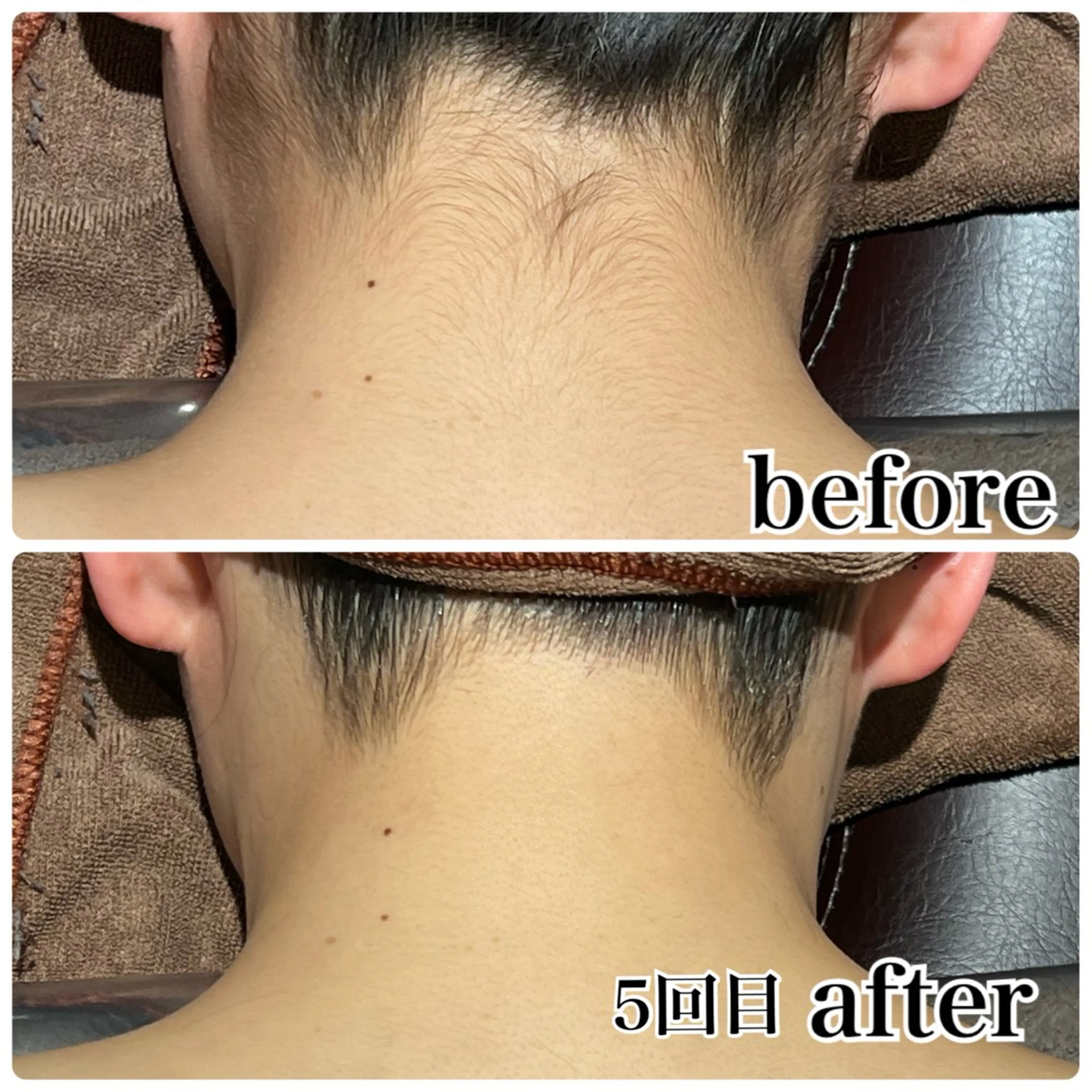 脇、うなじ脱毛の写真