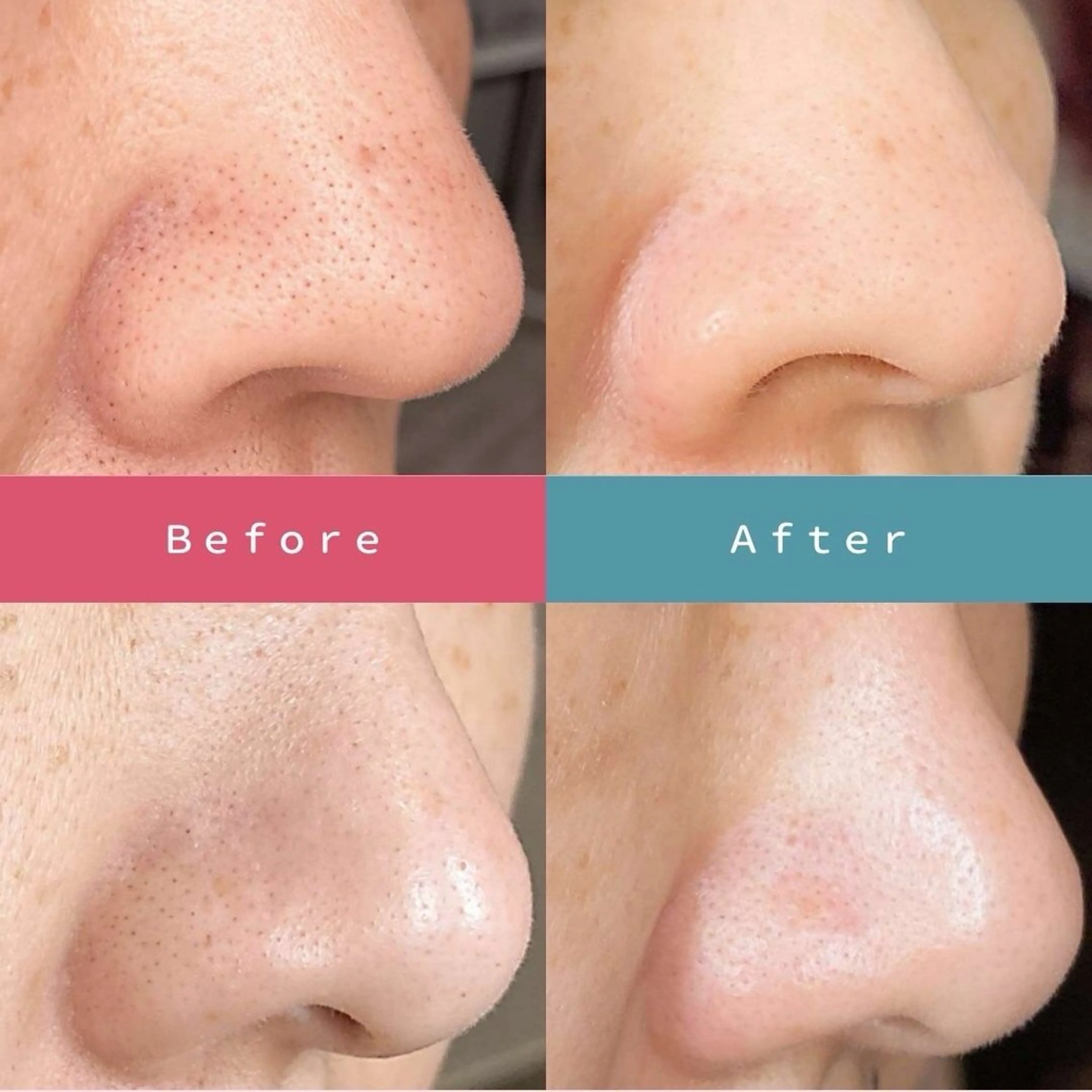 【ツルもち肌へ💆‍♀️】ハイドロ毛穴洗浄＆デコルテケアの写真