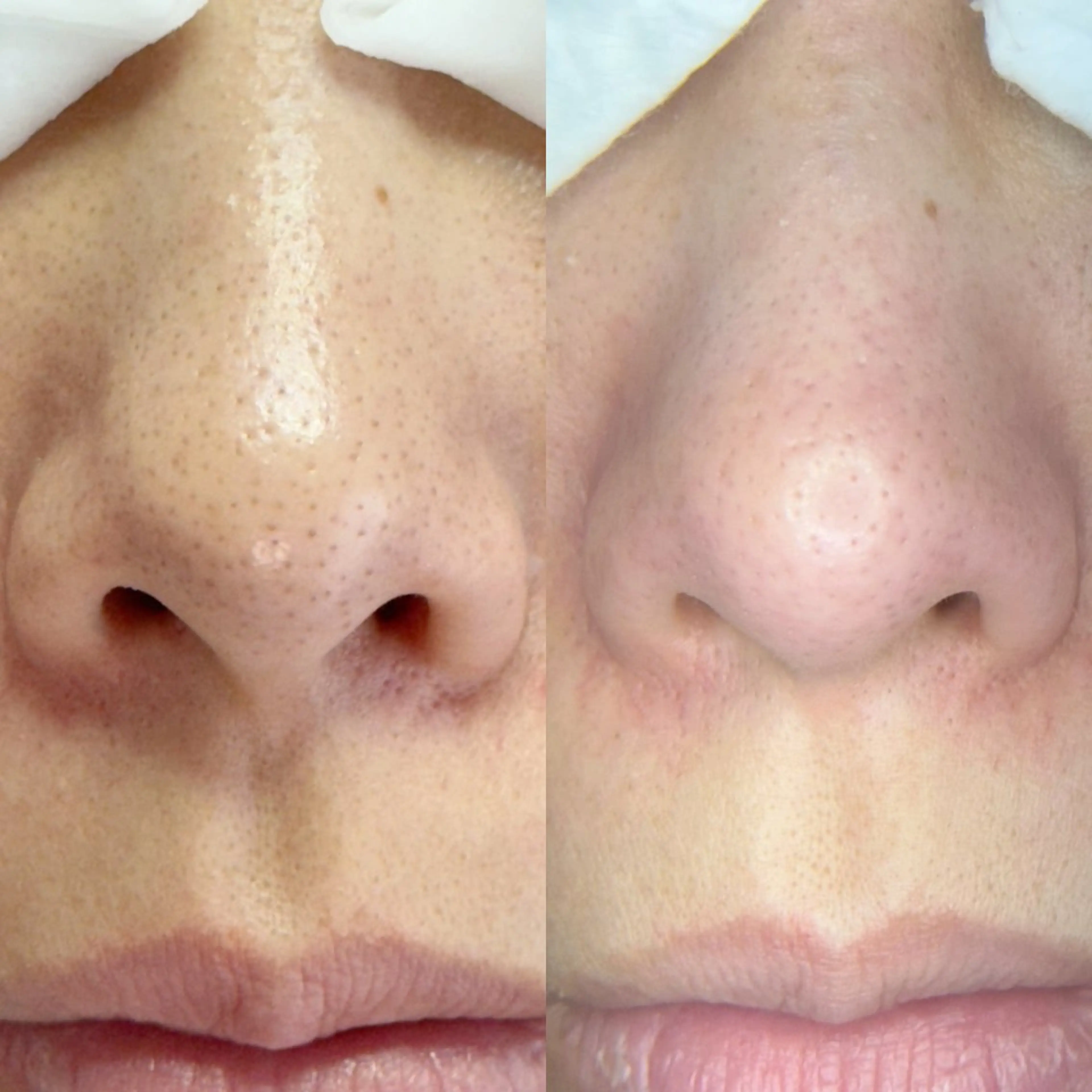 毛穴うる艶リセットコースの写真