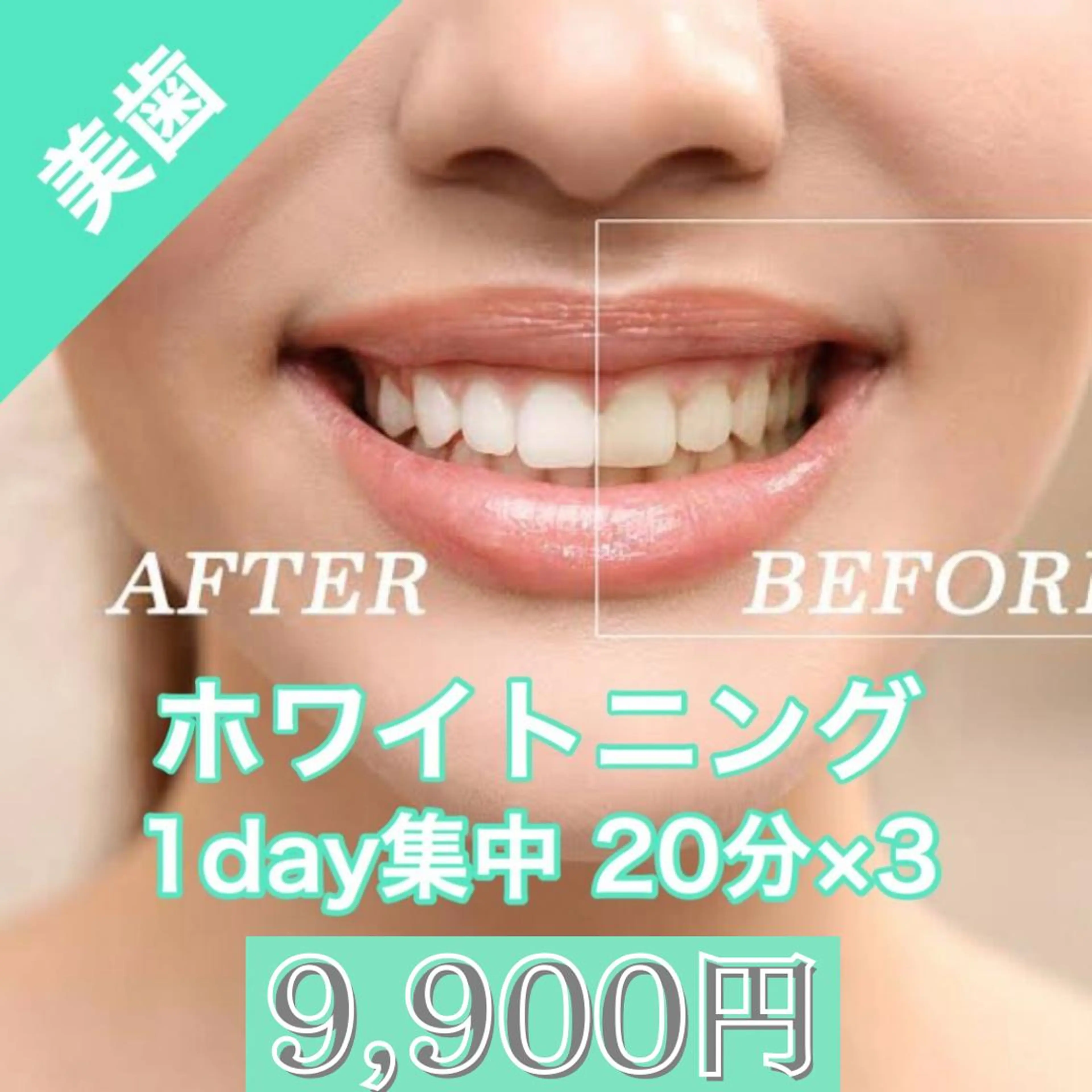 🦷セルフホワイトニング1DAY集中✨LED照射20分×3回！minimo限定❣️当日しっかり白くしたい方に💎の写真