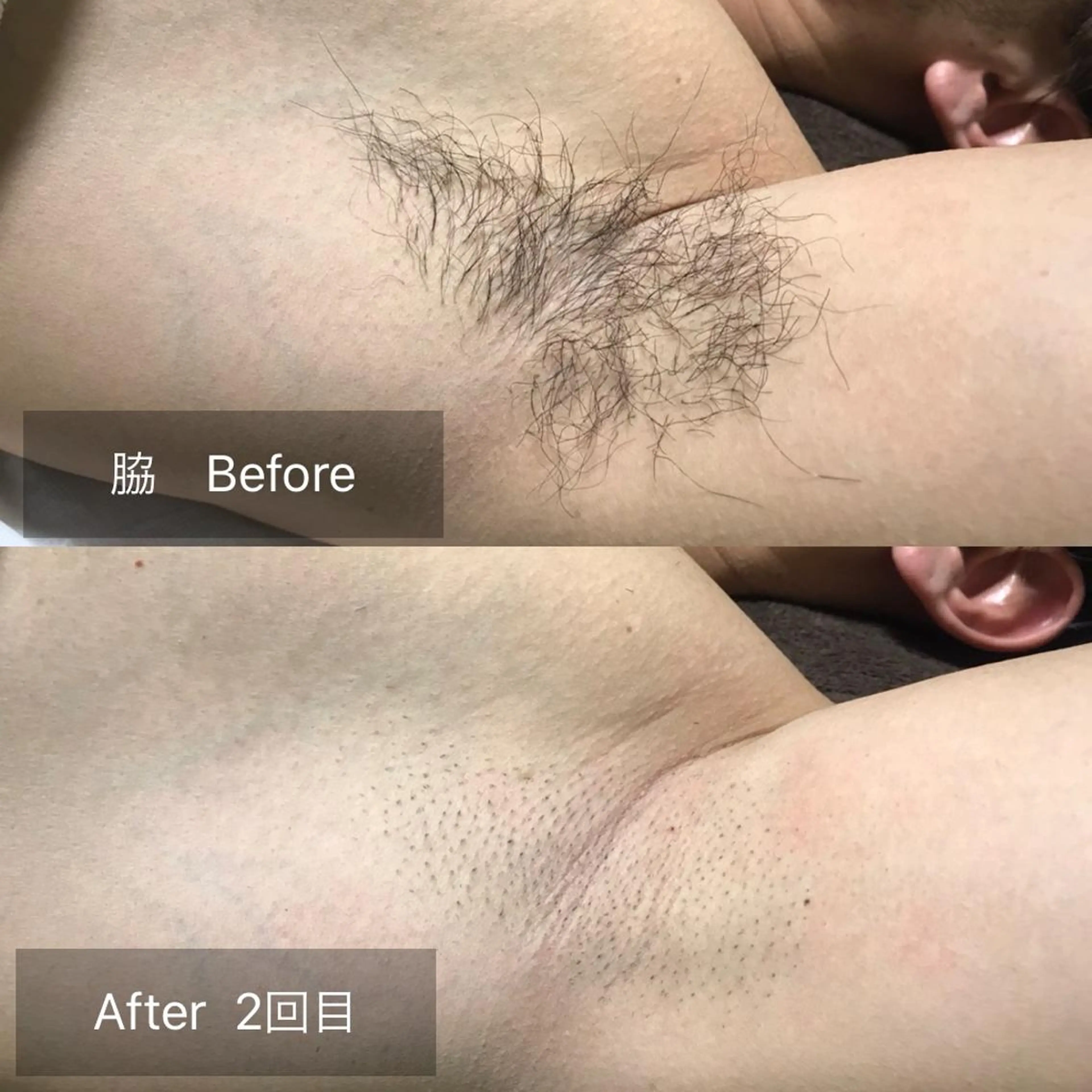 メンズ マンモス脱毛 札幌白石店のその他イメージ