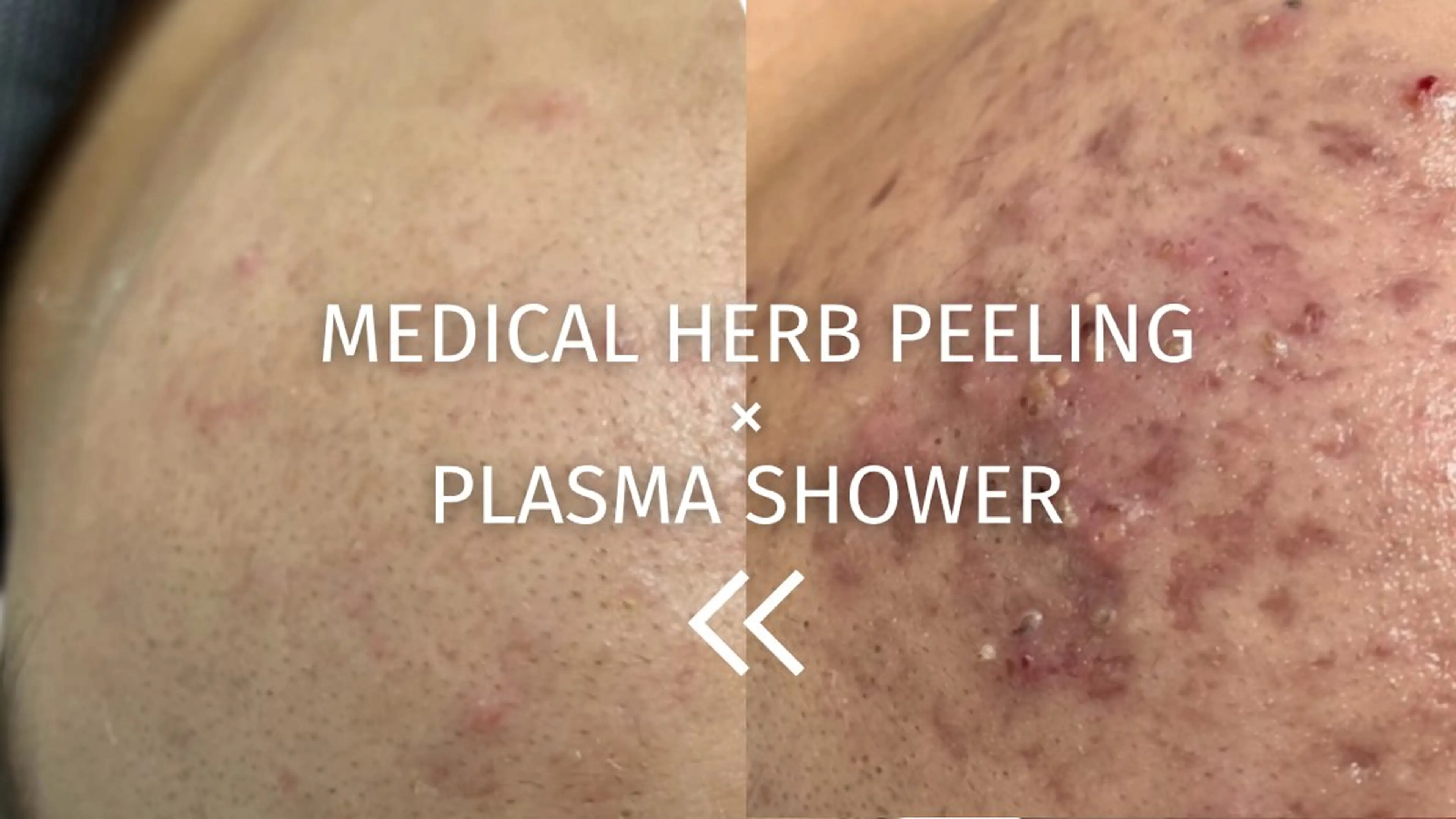 【本気のニキビケア】メディカルハーブピーリング×韓国プラズマシャワー⚡️の写真