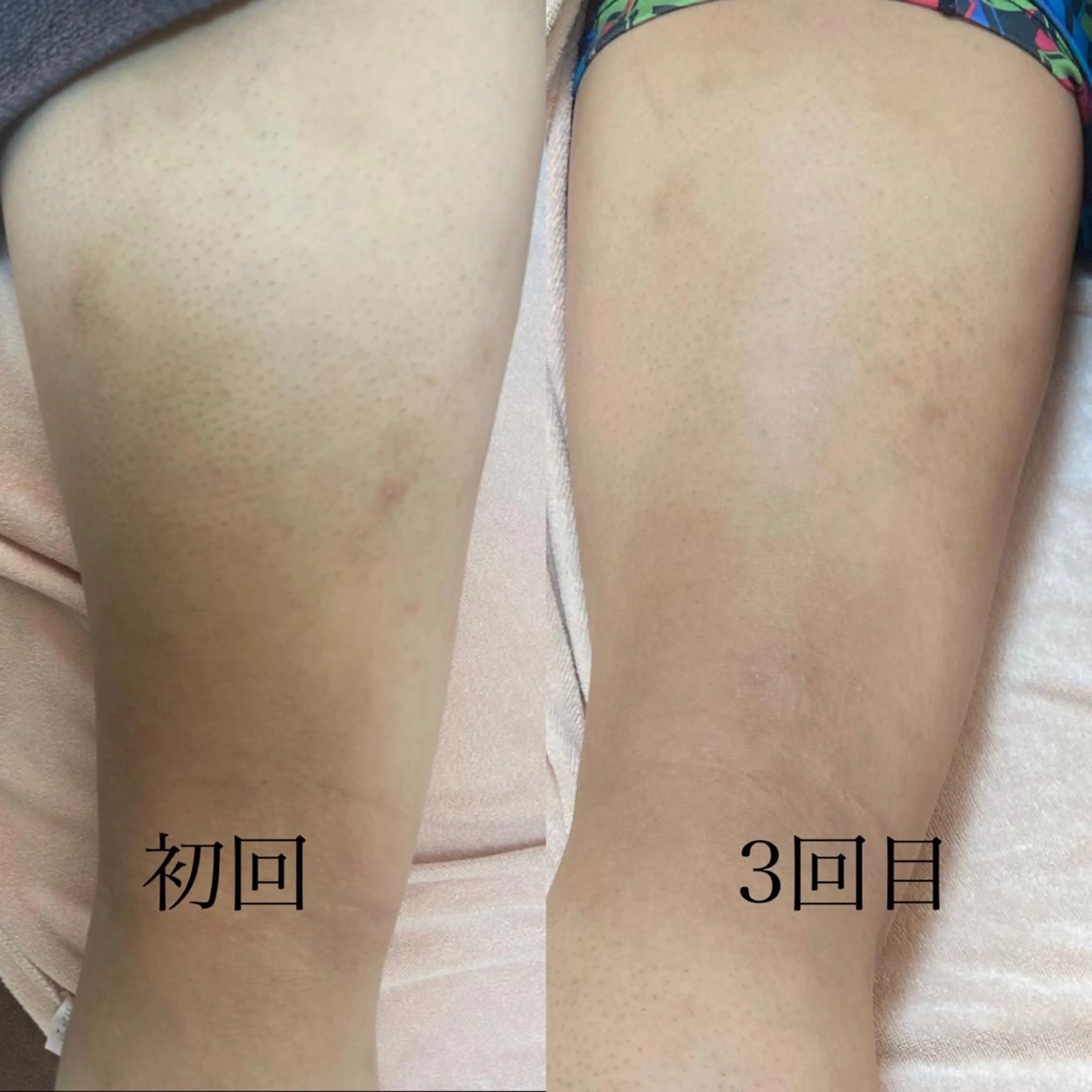 メンズ 脱毛 都度払い制脱毛サロンBe Charm所属・Be Charm 山﨑のエステ・リラクイメージ