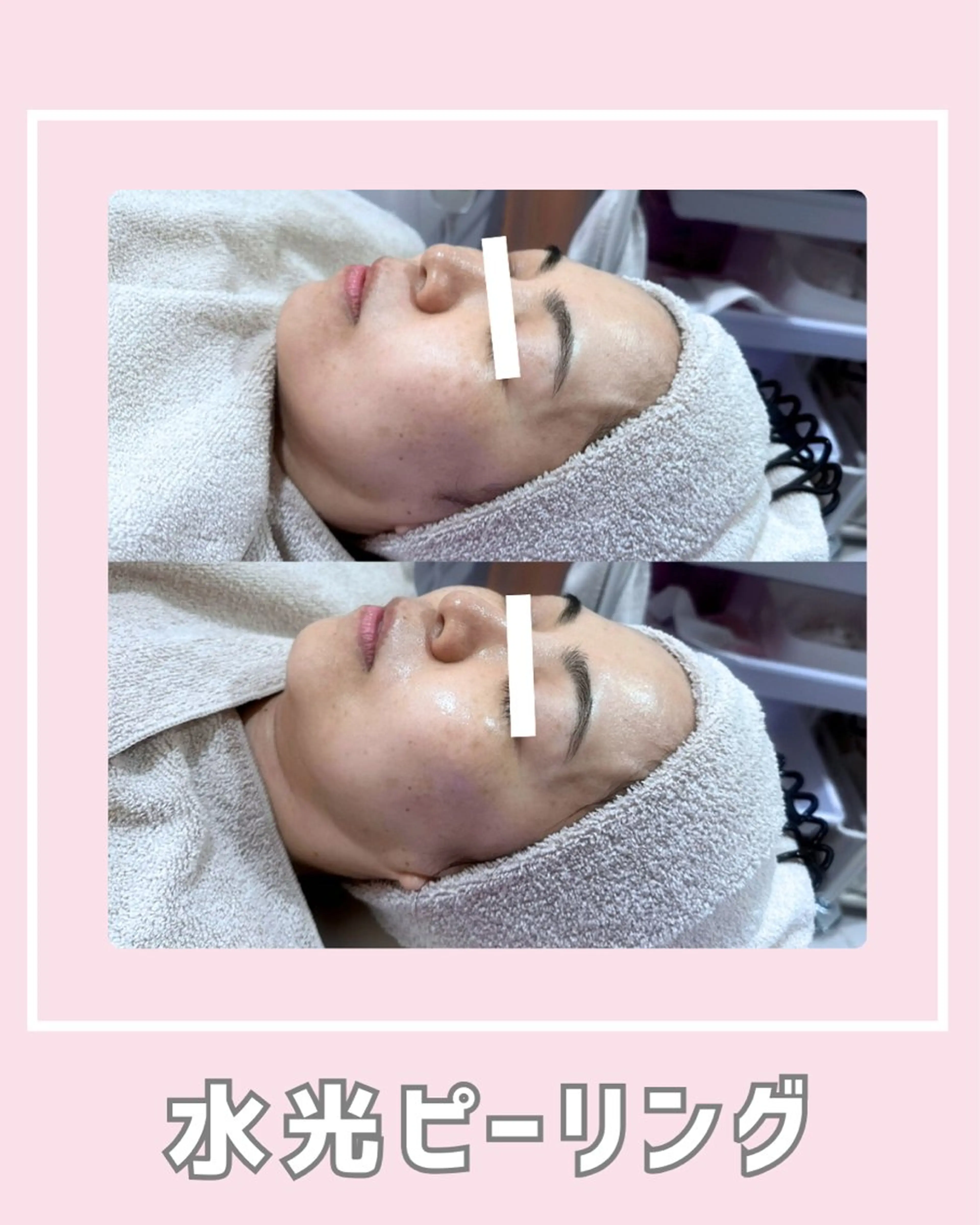 エステ |ピーリング・毛穴| soina神楽坂のエステ・リラクイメージ