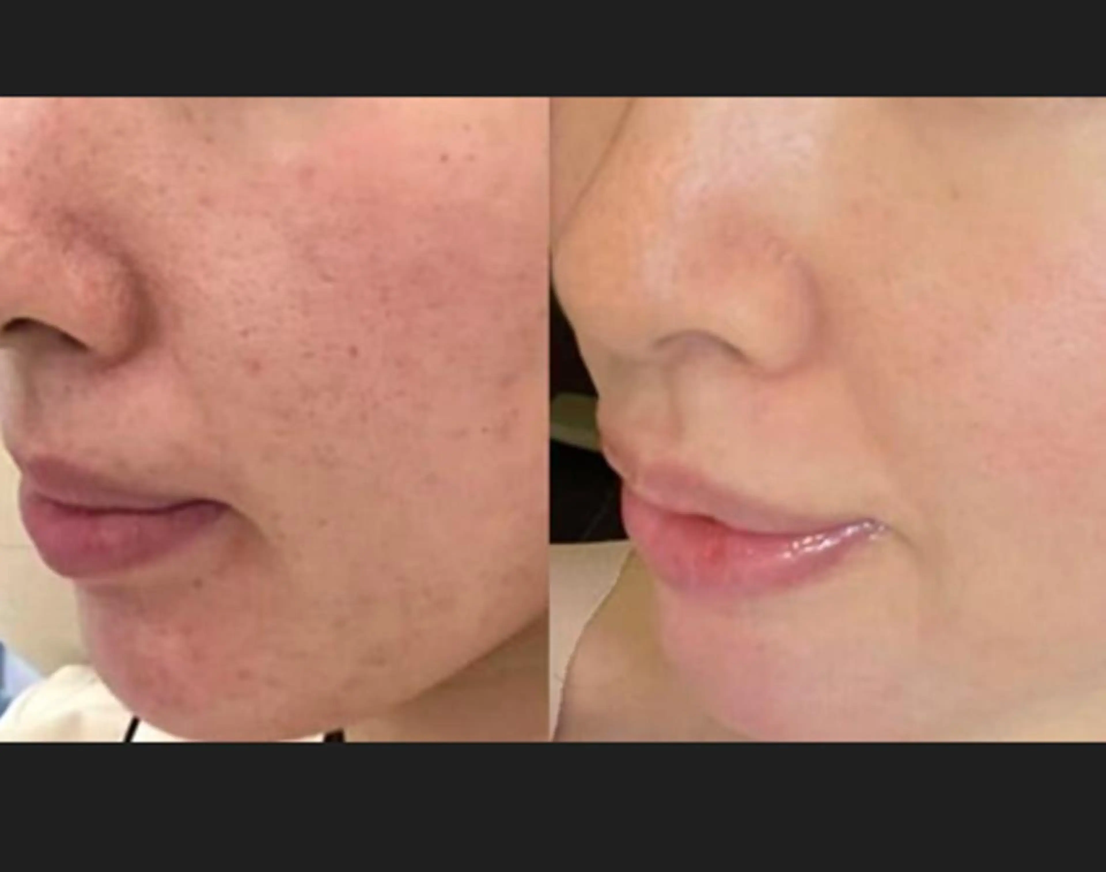 🫢❣️🫢❣️🫢❣️【SET人気No.1】グリーンピール薄皮を丁寧に取り除きます60分 ¥11000の写真