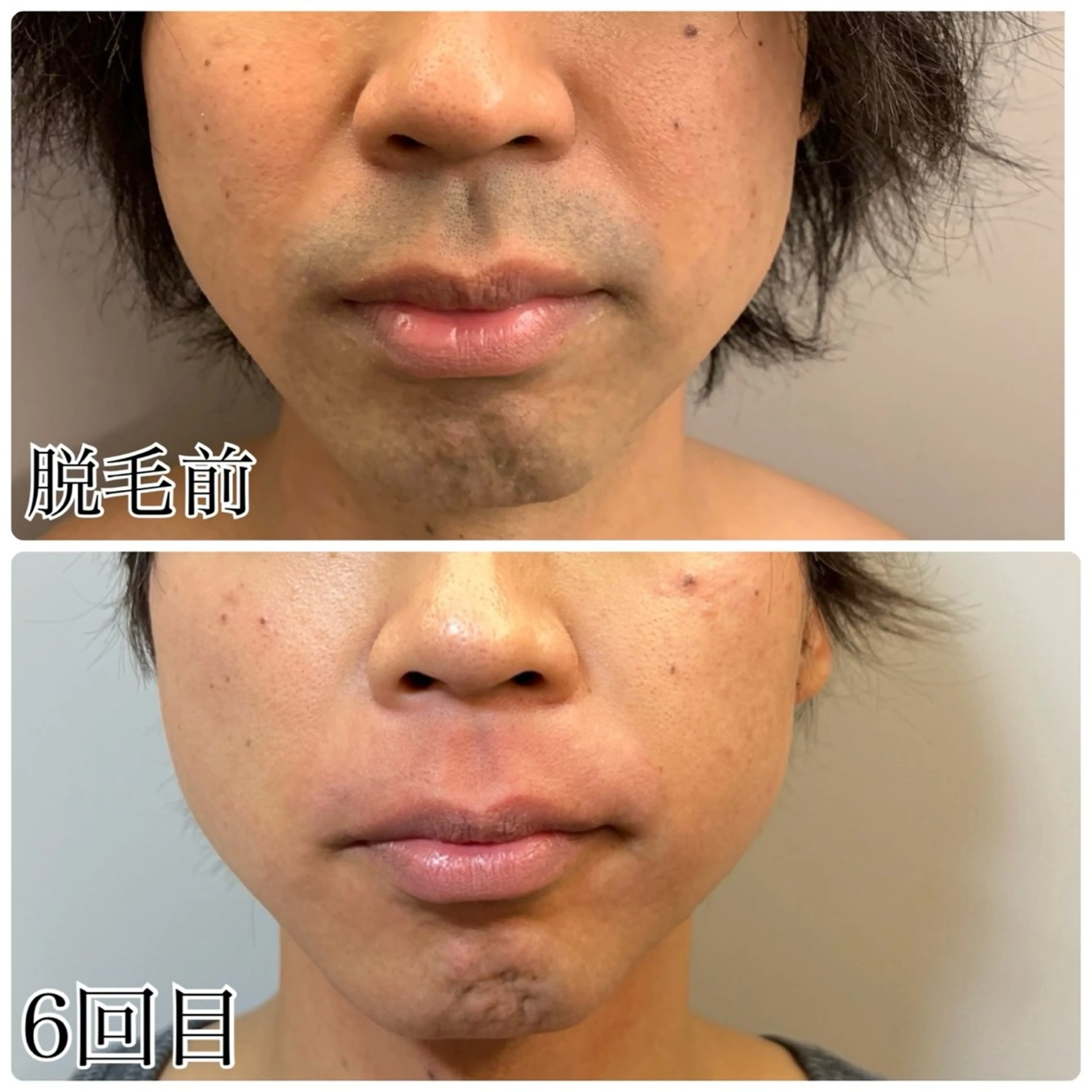 メンズ 脱毛 毛穴洗浄特化🫧 オオツカのエステ・リラクイメージ