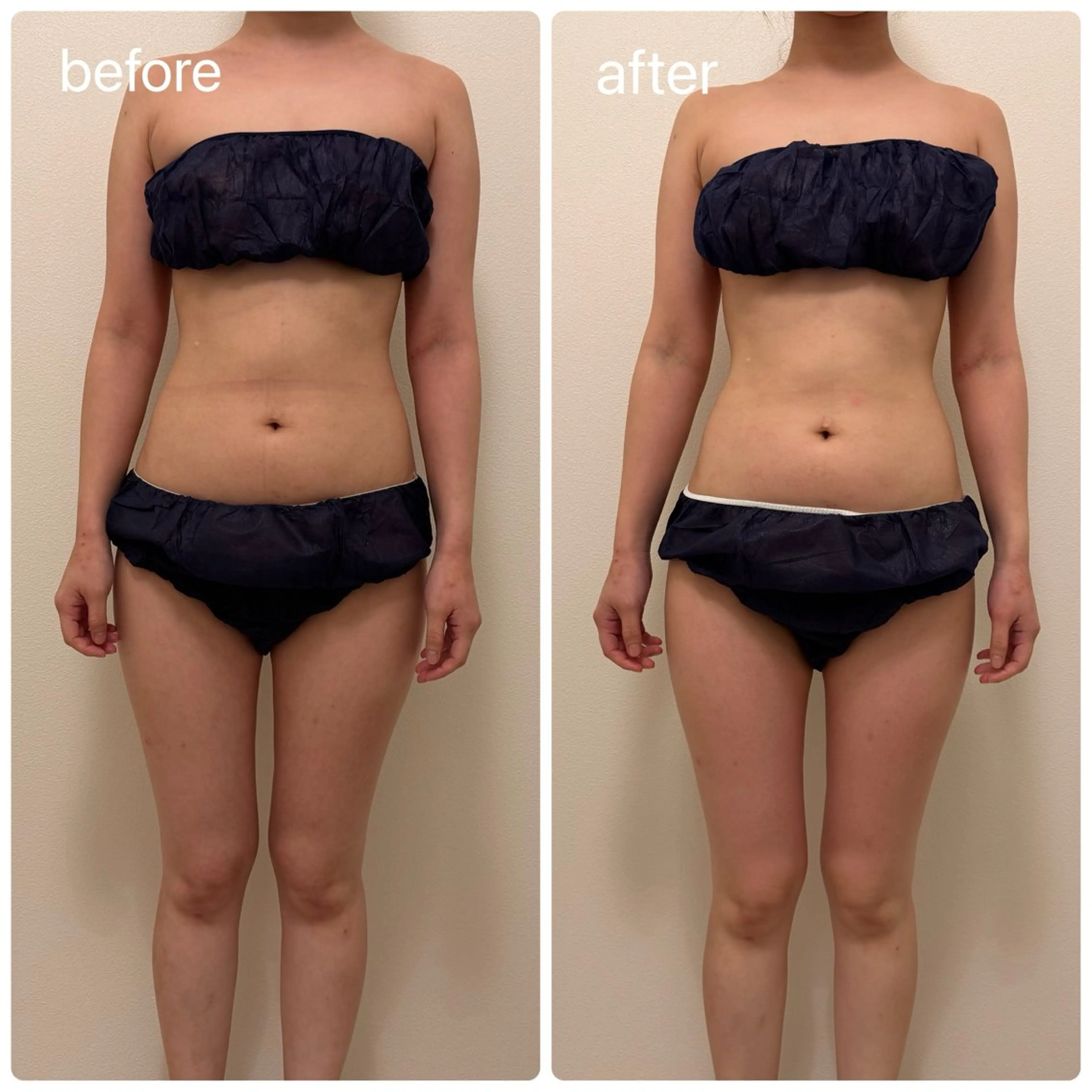 結果重視の痩身！ハイパーナイフ全身60分の写真