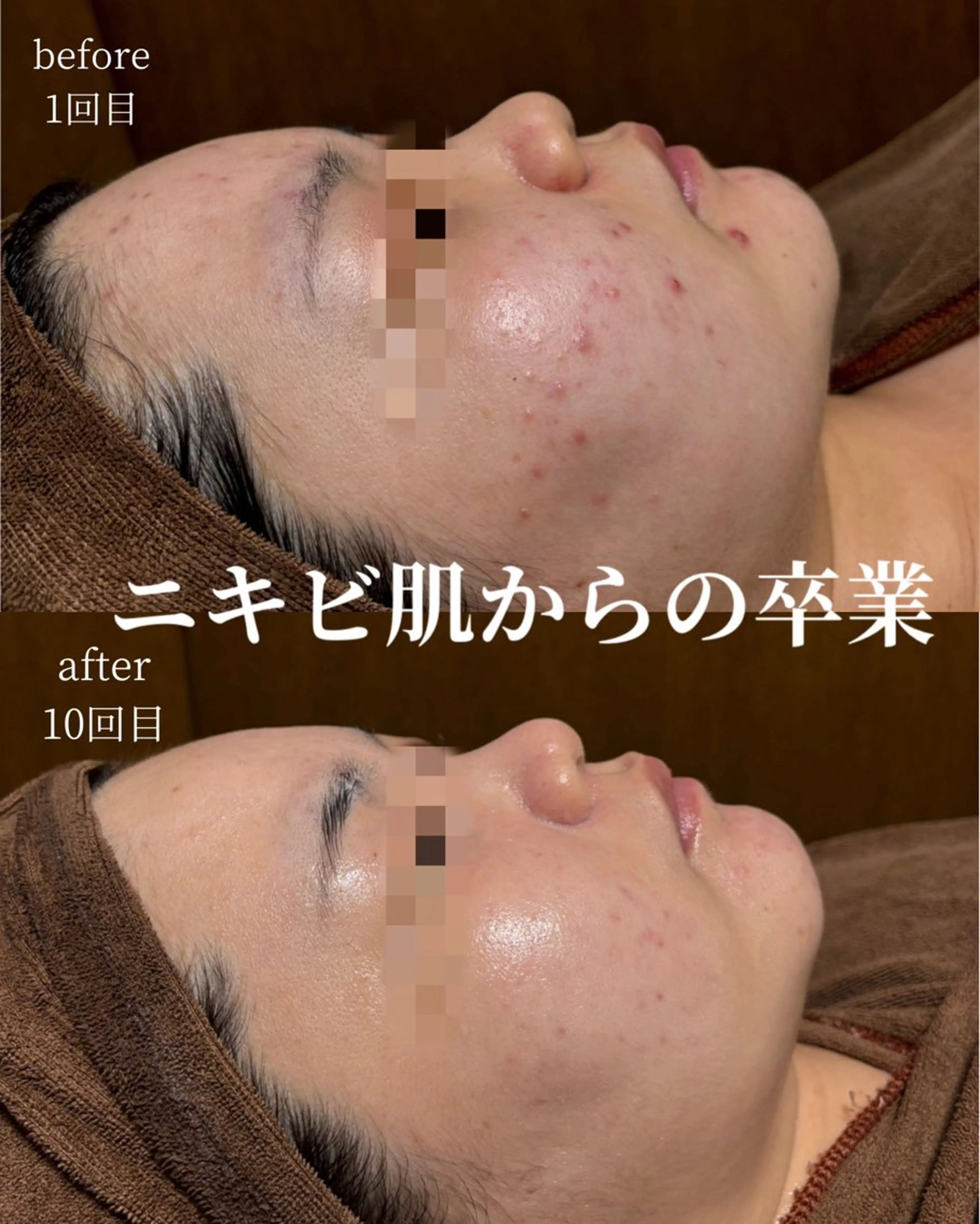 HINANO矢場町店【ヒナノ】所属・脱毛/肌改善🌿 HINANO 村田のエステ・リラクイメージ