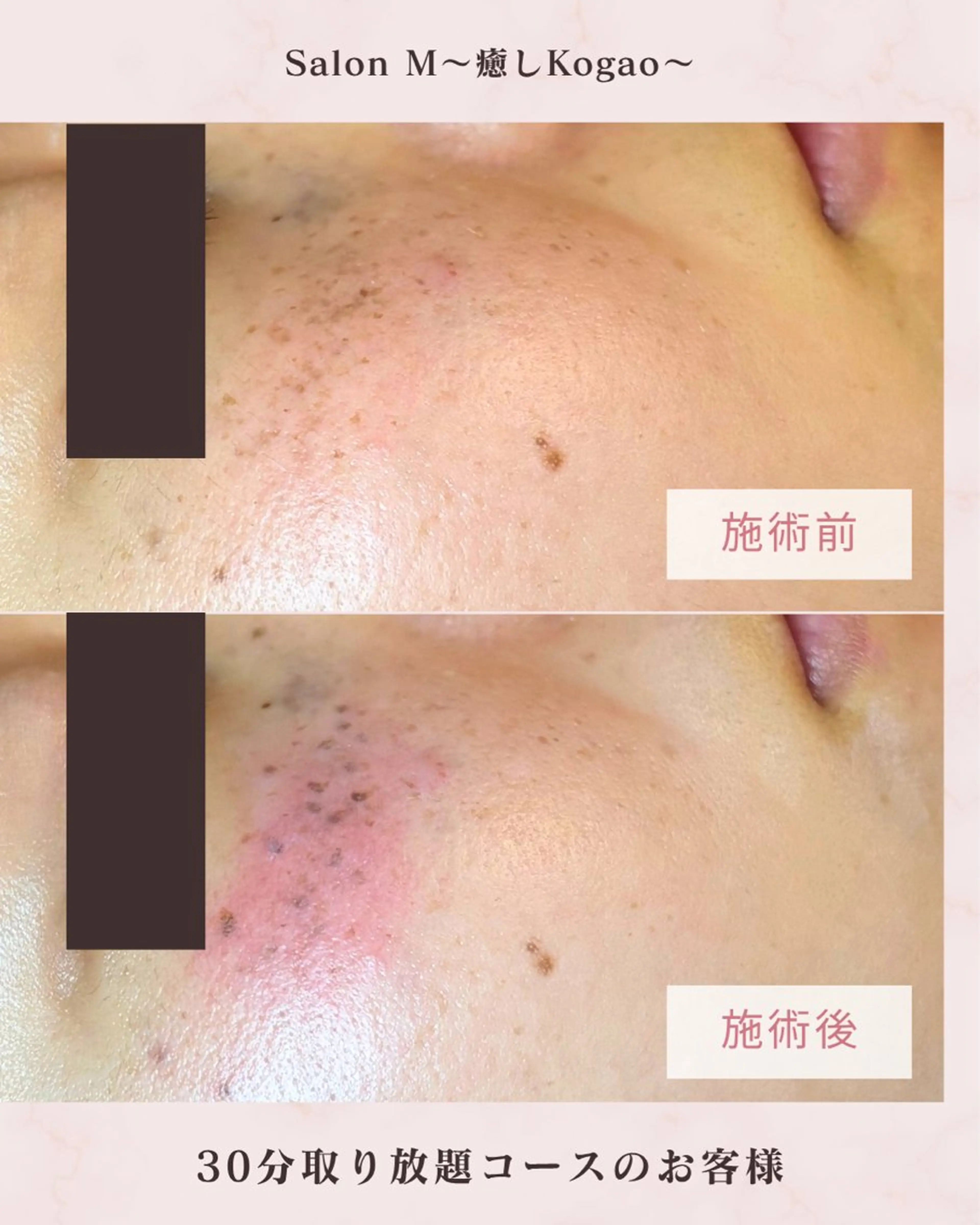 【モニター募集】⭐️伏見店限定⭐️シミ撃退！！30分取り放題コース！そばかすや肝斑も可能✨の写真