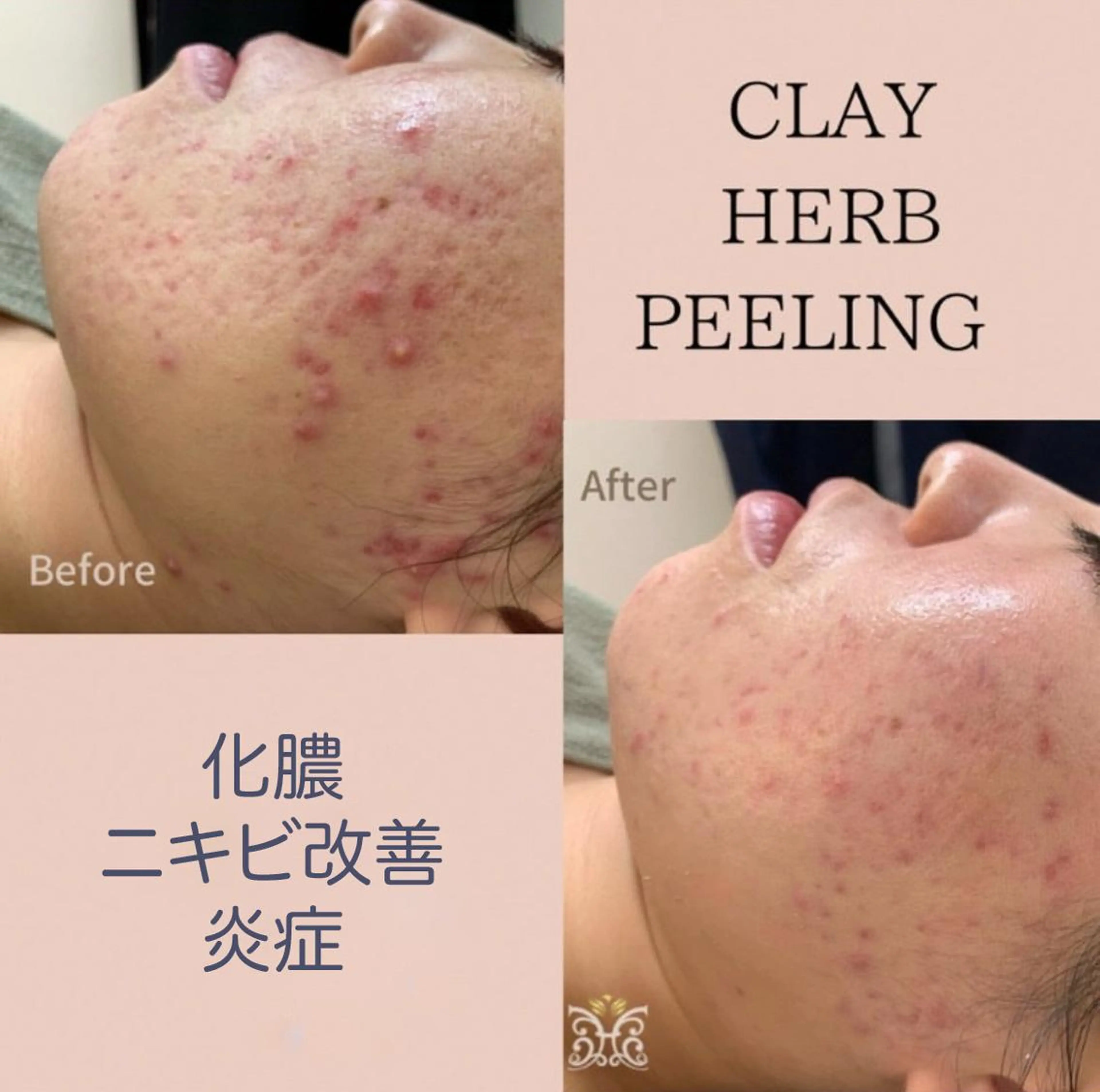 【ハーブピーリング&アロマリンパマッサージ nana】医療提携サロン所属・美肌&アロマ🌸 nana 中目黒のエステ・リラクイメージ