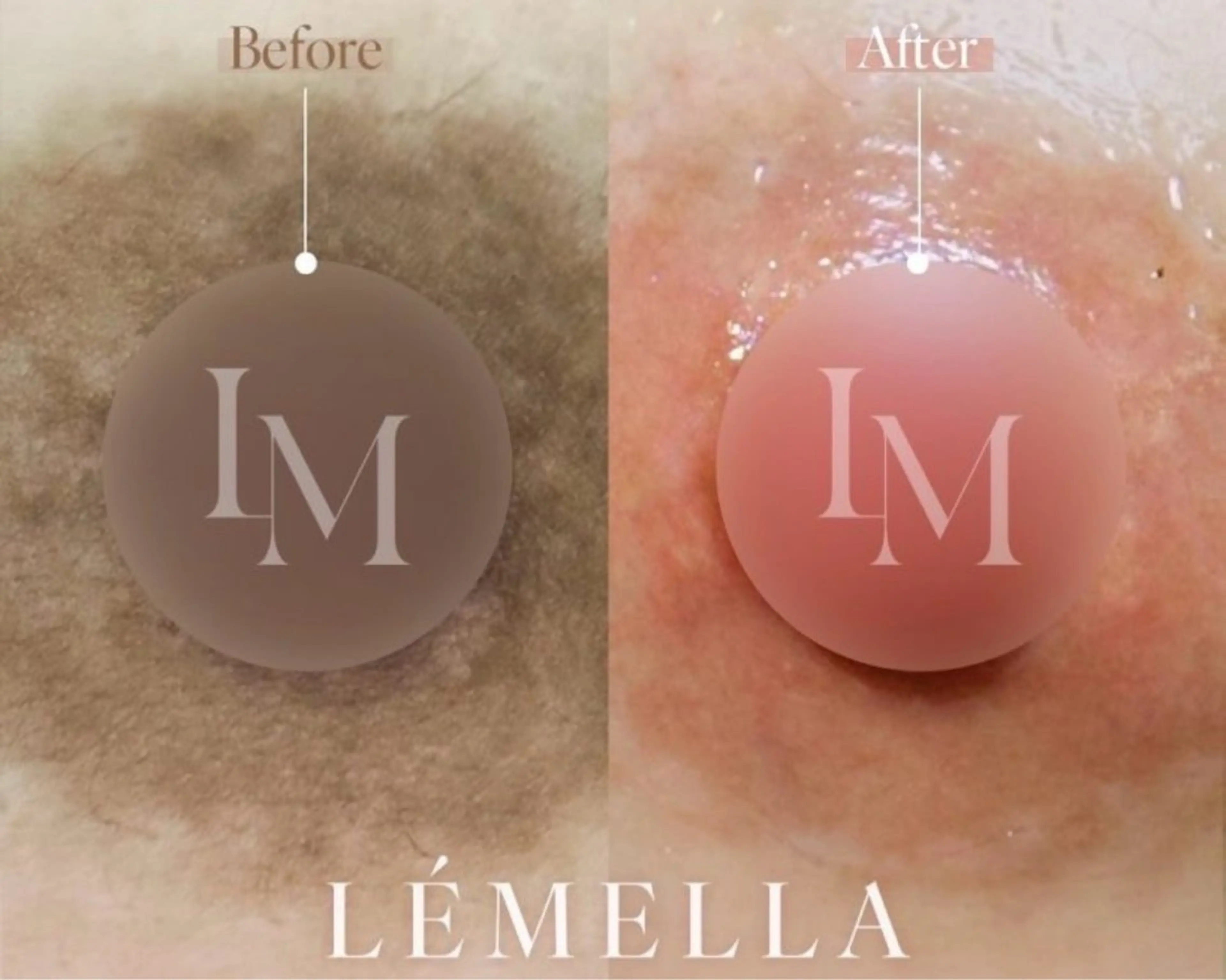 2名限定❣️効果は半永久！ルメラモニター！リップor乳輪の写真