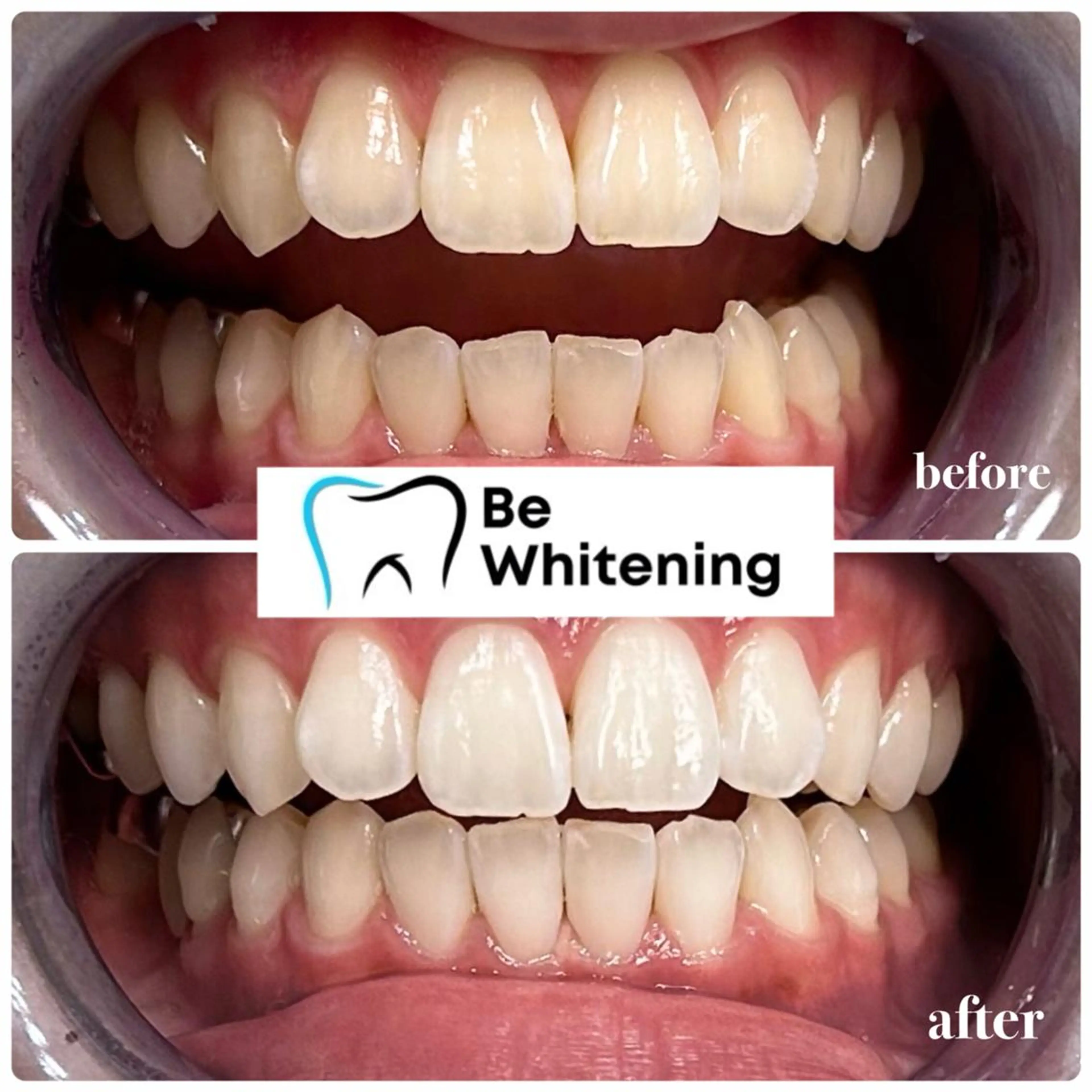 🥇人気No.1🥇まずはお試し【️ 15分照射×2回】セルフホワイトニング¥8800→¥3300(1日完結)の写真