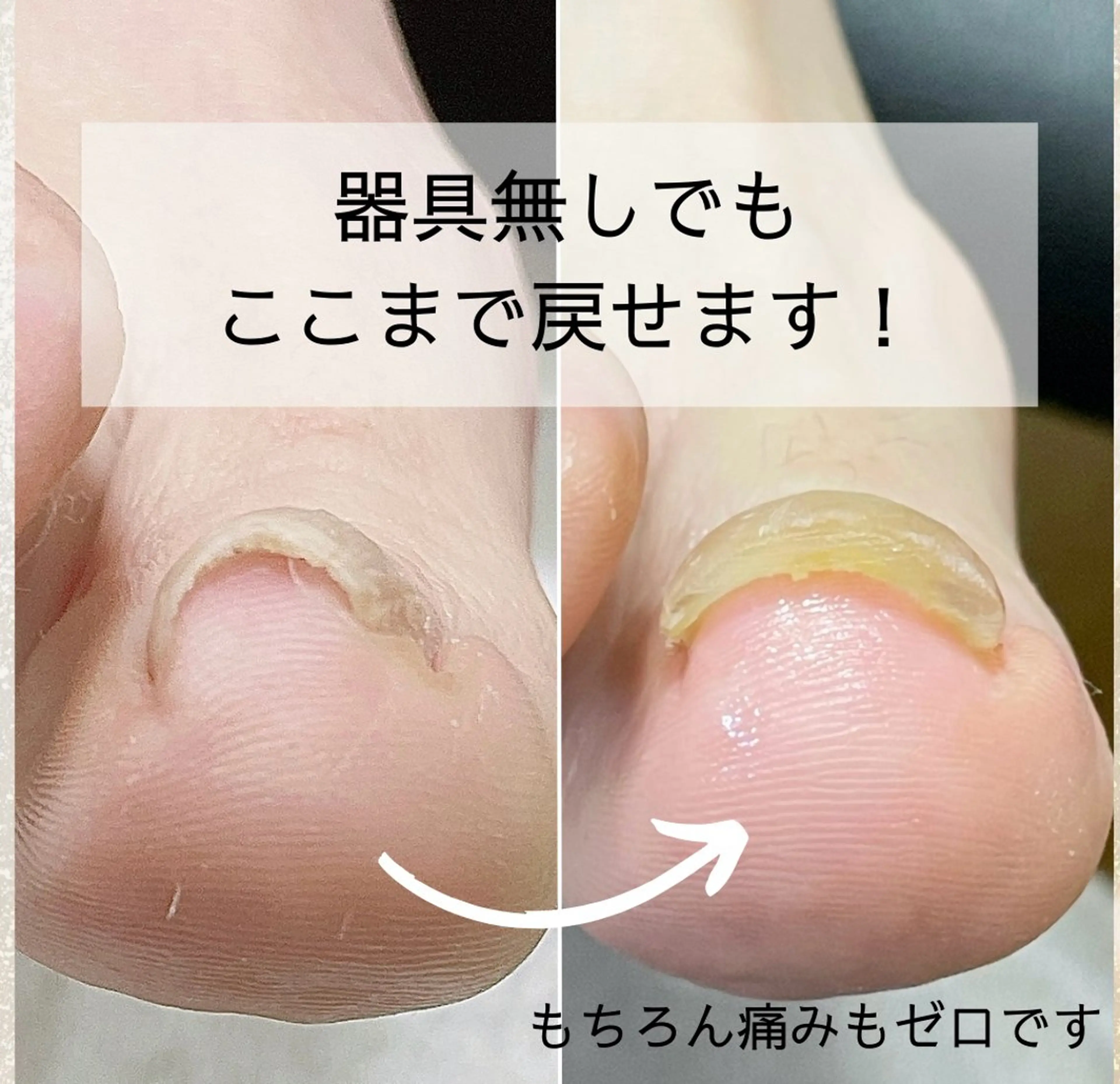 ネイル 深爪・巻き爪 専門サンセリテのネイルデザイン