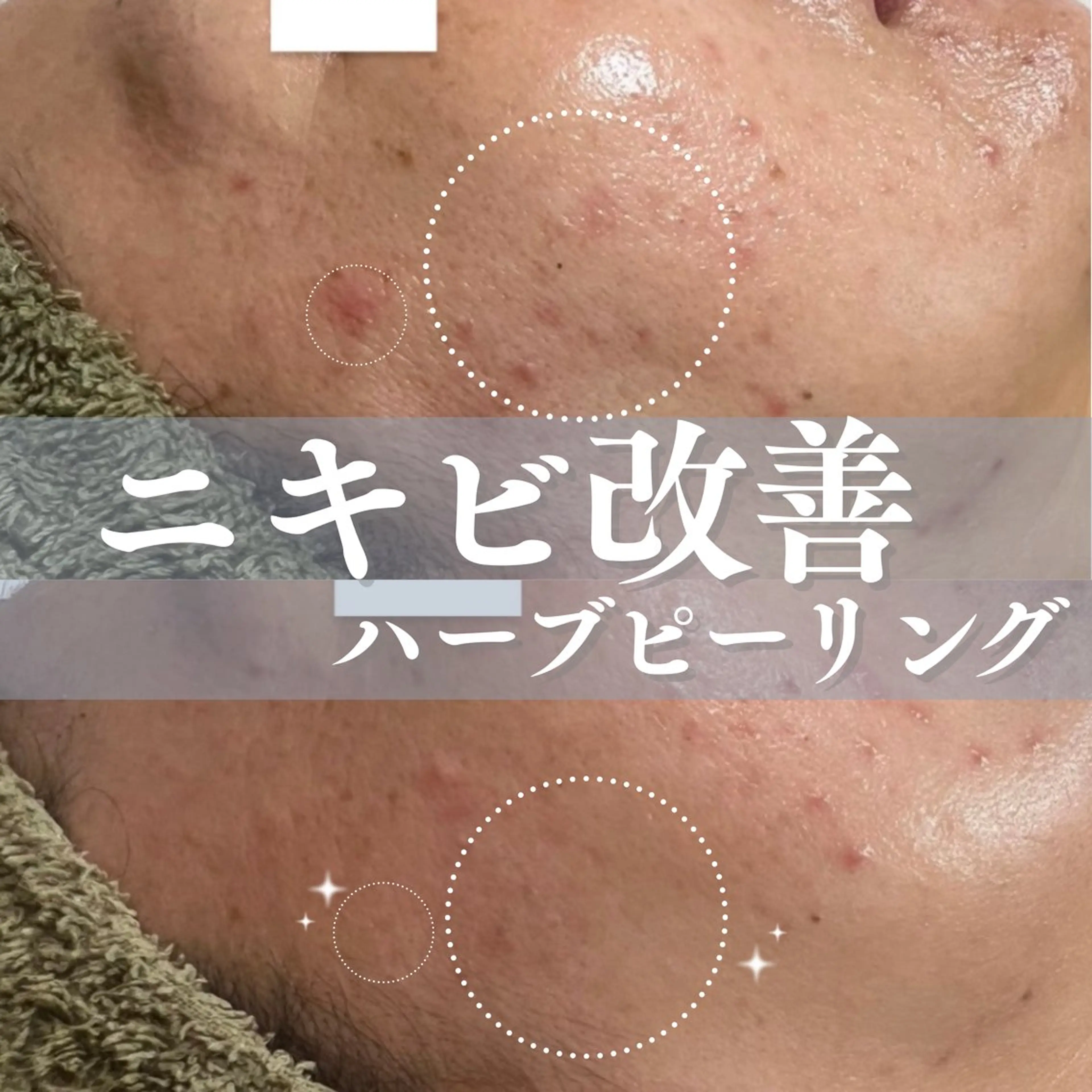 【ニキビ・毛穴改善】剥けないハーブピーリング＋選べる美肌オプション1種＋ipsp幹細胞仕上げ　定価18,150円の写真