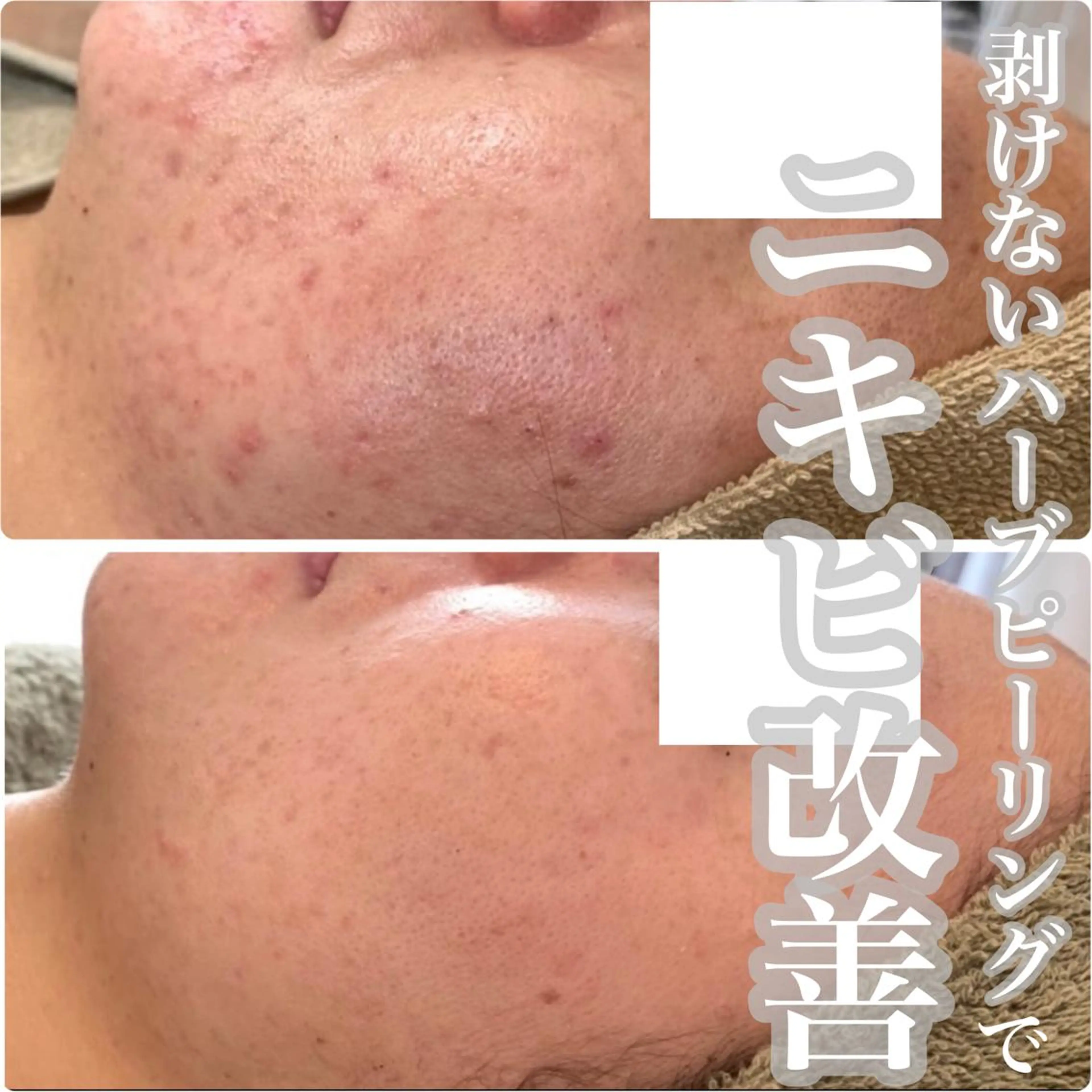 エステ ニキビ・毛穴改善 🌿ハーブピーリングのエステ・リラクイメージ