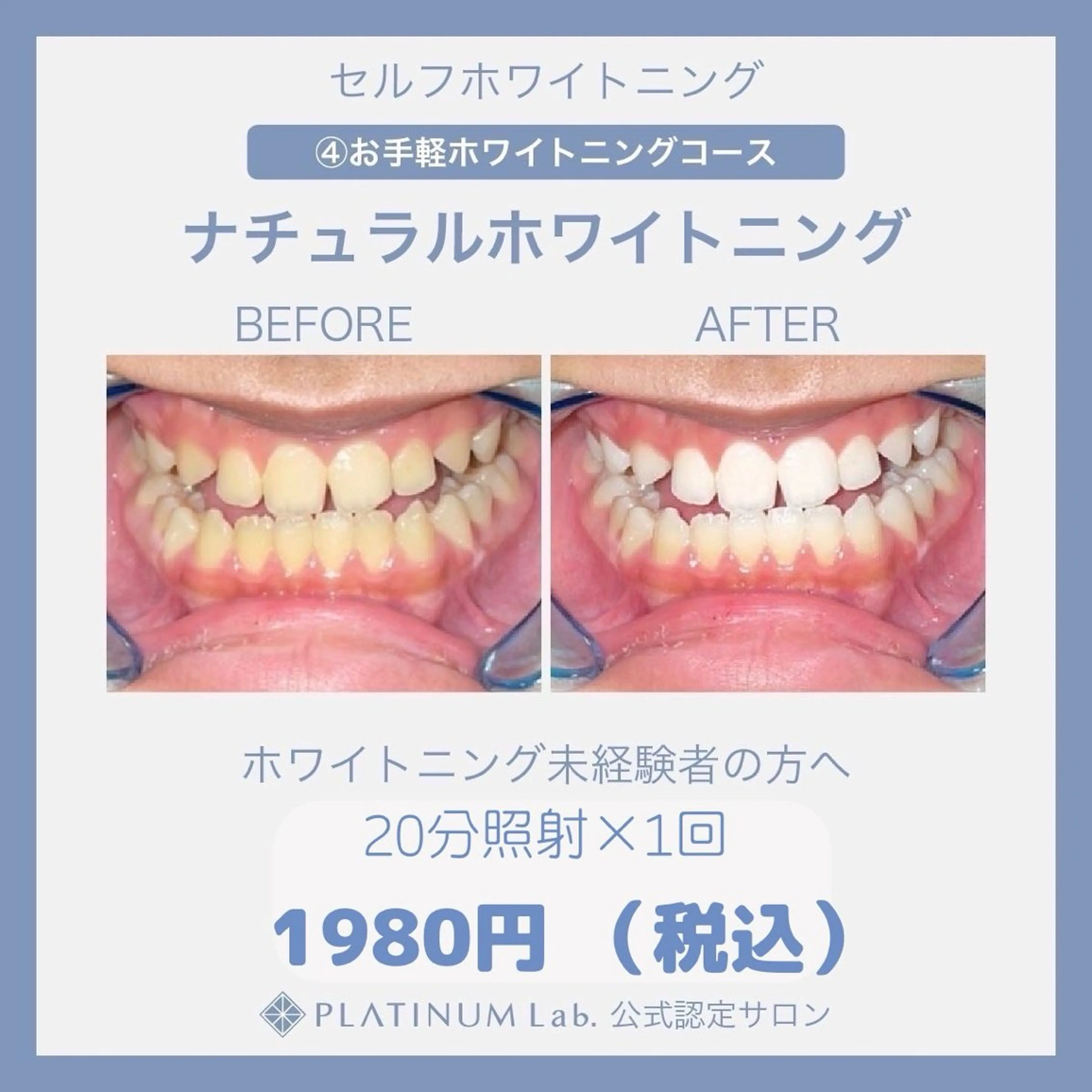 【minimo限定】ナチュラルセルフホワイトニング(20分照射) メンズ歓迎👨✨️の写真