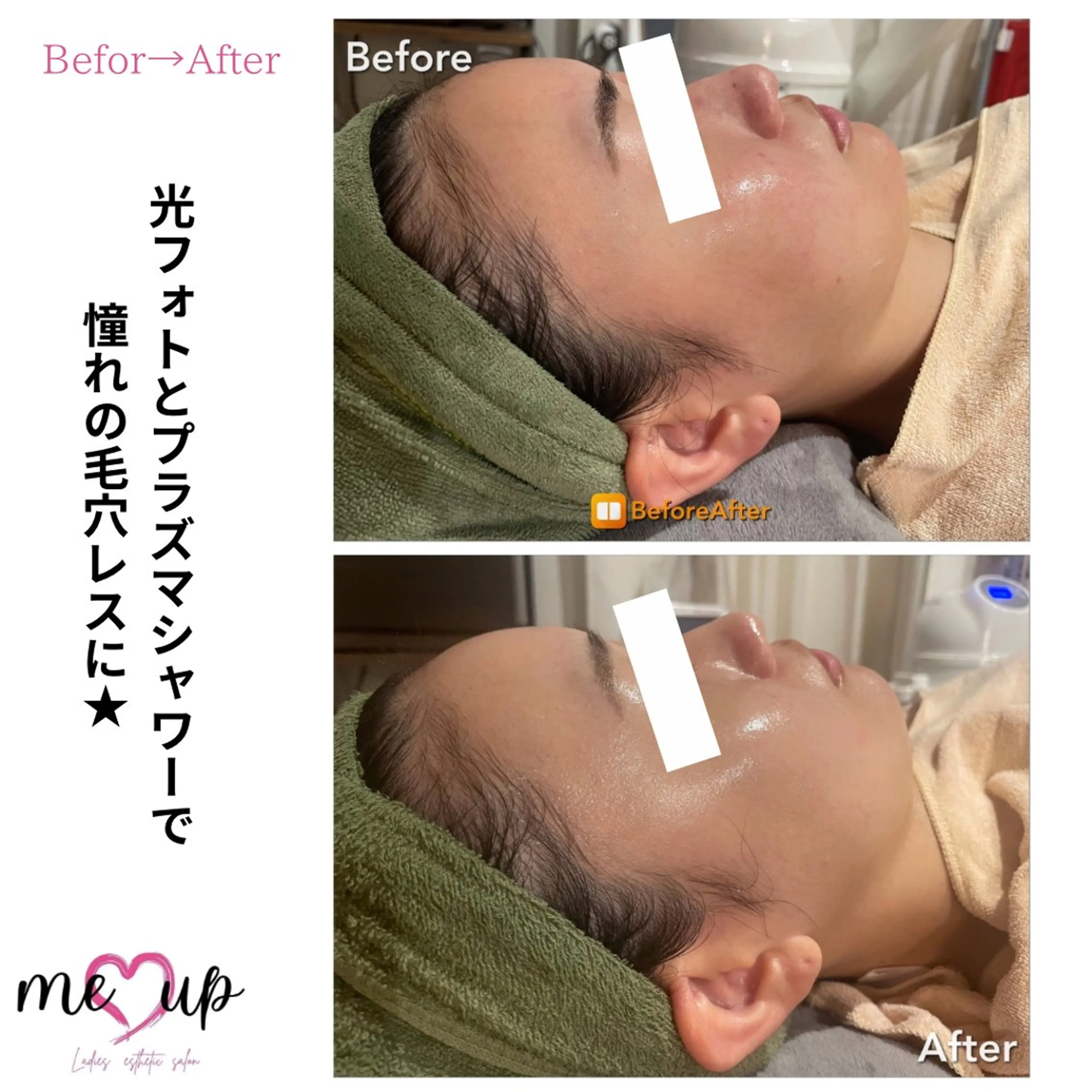 エステ Meupニキビ専門店 背中/ハーブ/肌管理のその他イメージ