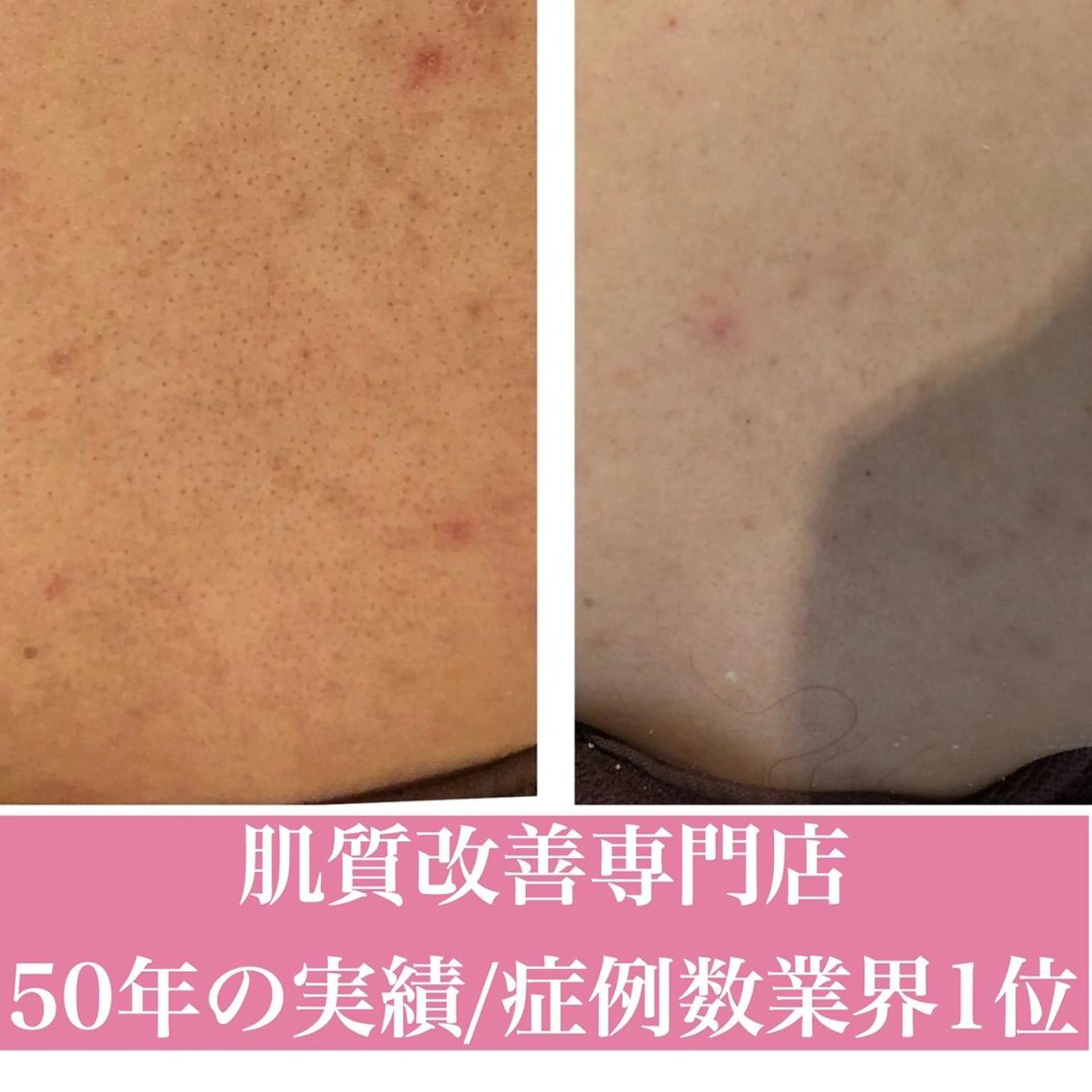 ニキビ跡改善専門🔥 医療にはできない改善のエステ・リラクイメージ