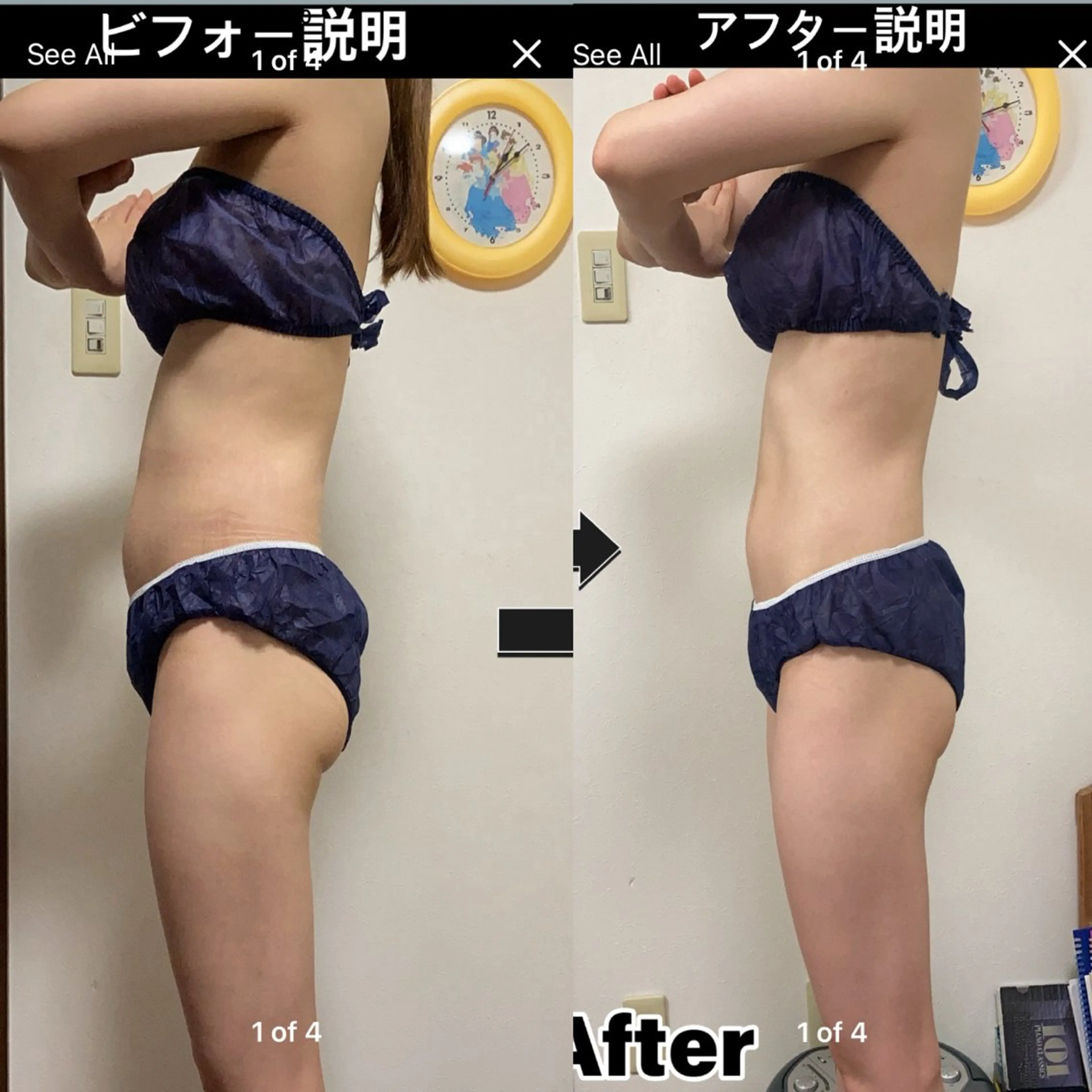 キャビテーション　痩身の写真