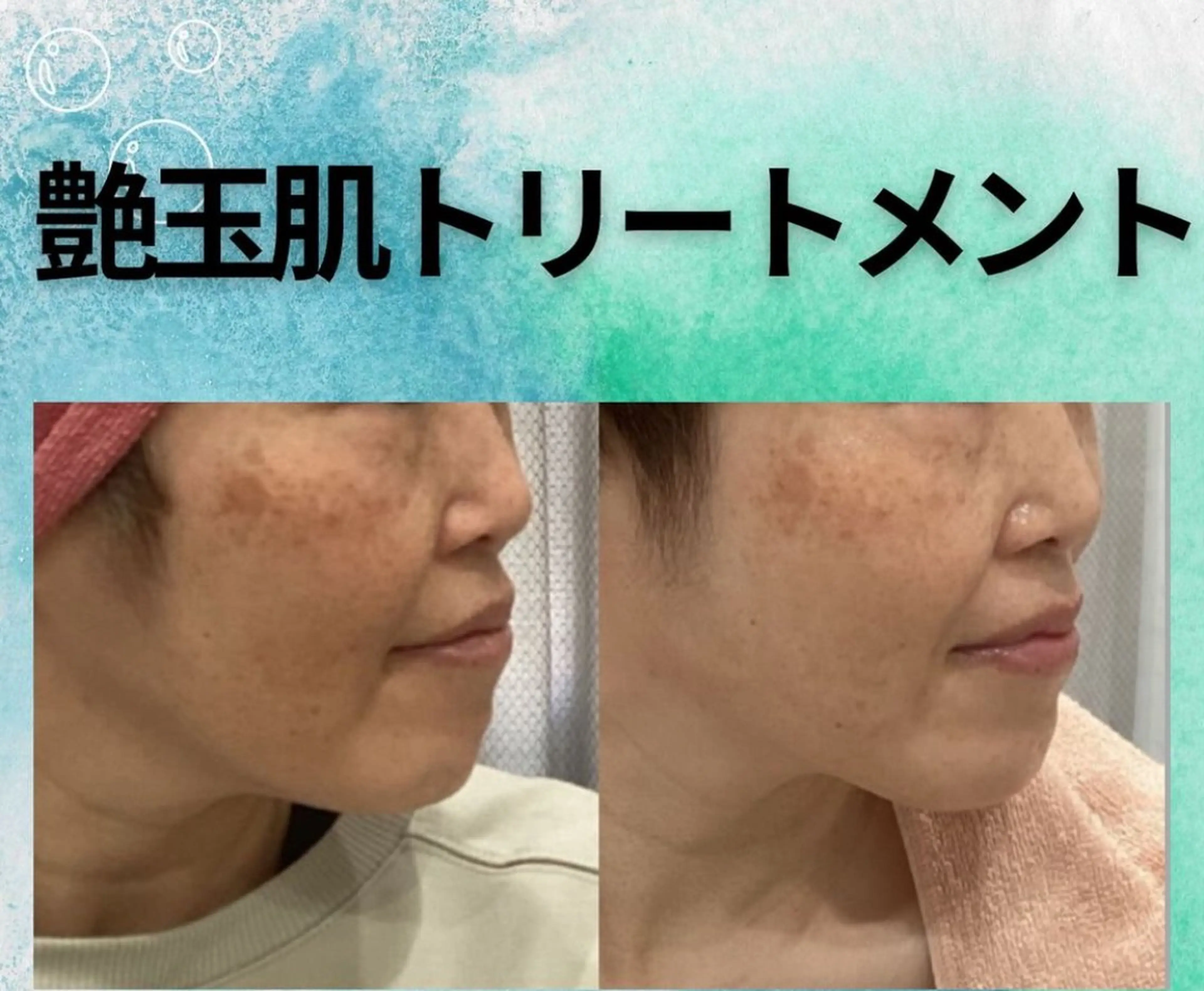 【韓国女優のような陶器肌】🧡つるりん毛穴レス体験🧡[兵庫県尼崎市/痩身エステ]の写真