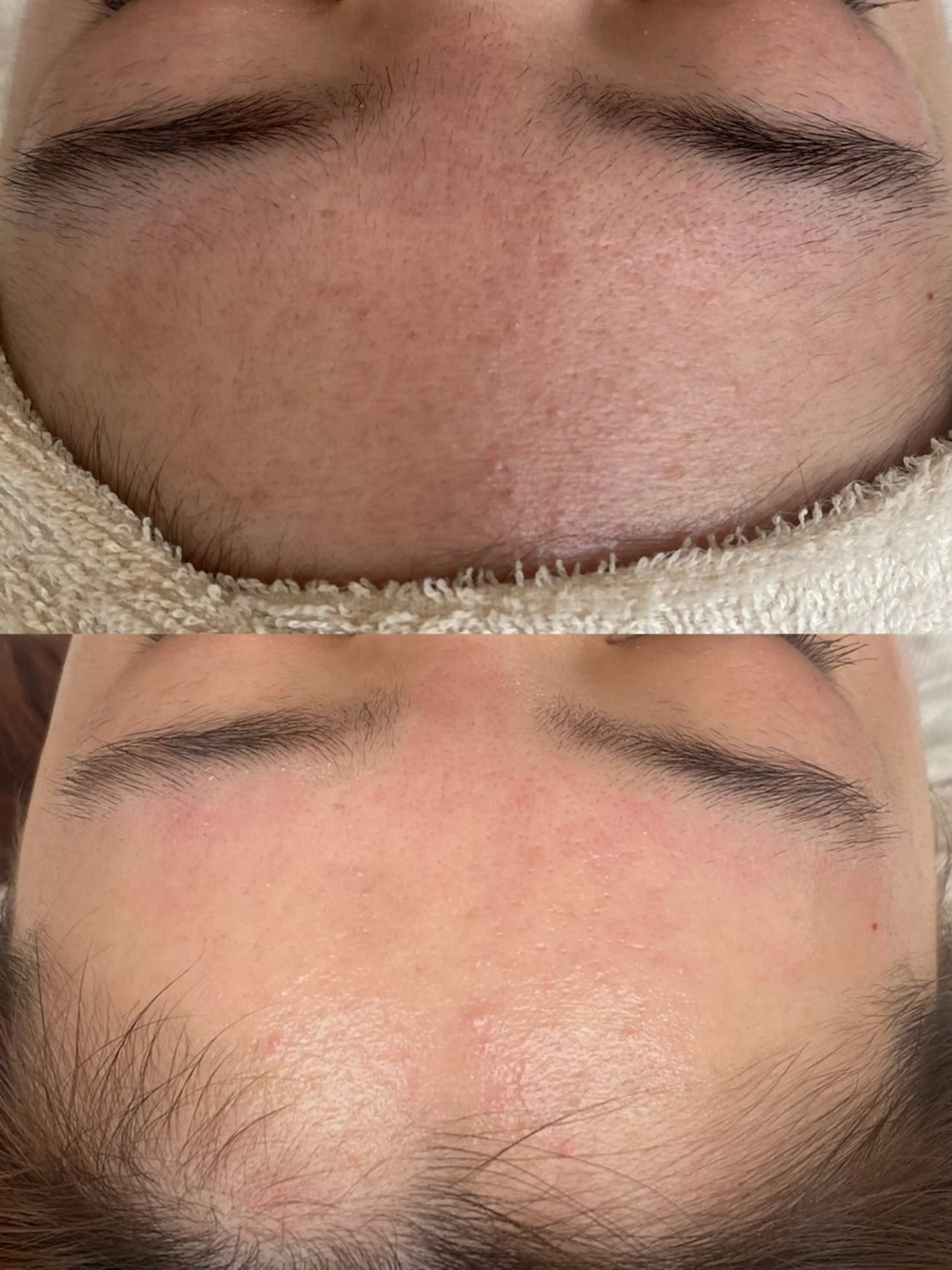 オプション●各パーツのみWax脱毛！他のメニューと組み合わせ(口周りのみ、鼻のみ、おでこのみ等)の写真