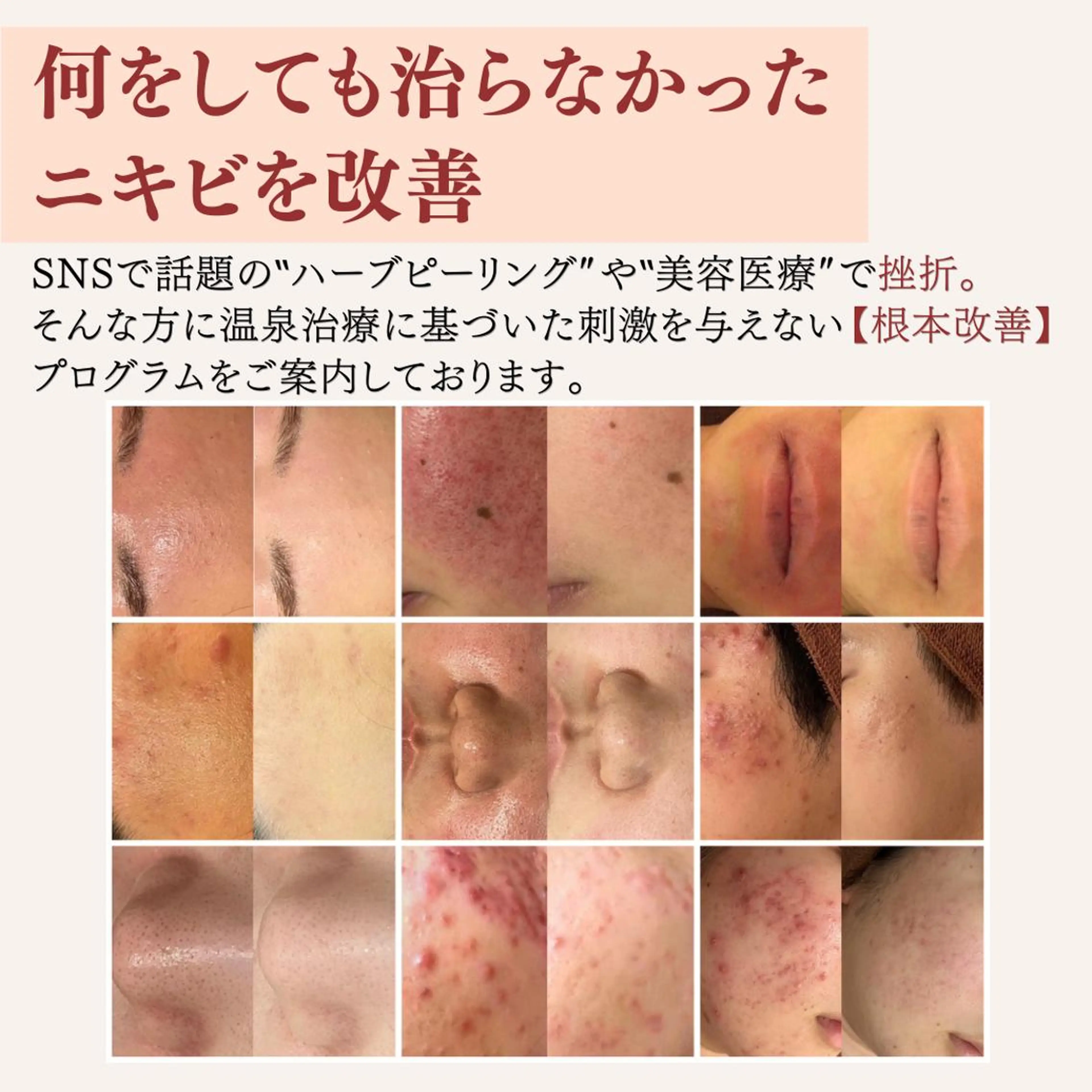 重度ニキビ専門🌷 ダウンタイムなしのエステ・リラクイメージ