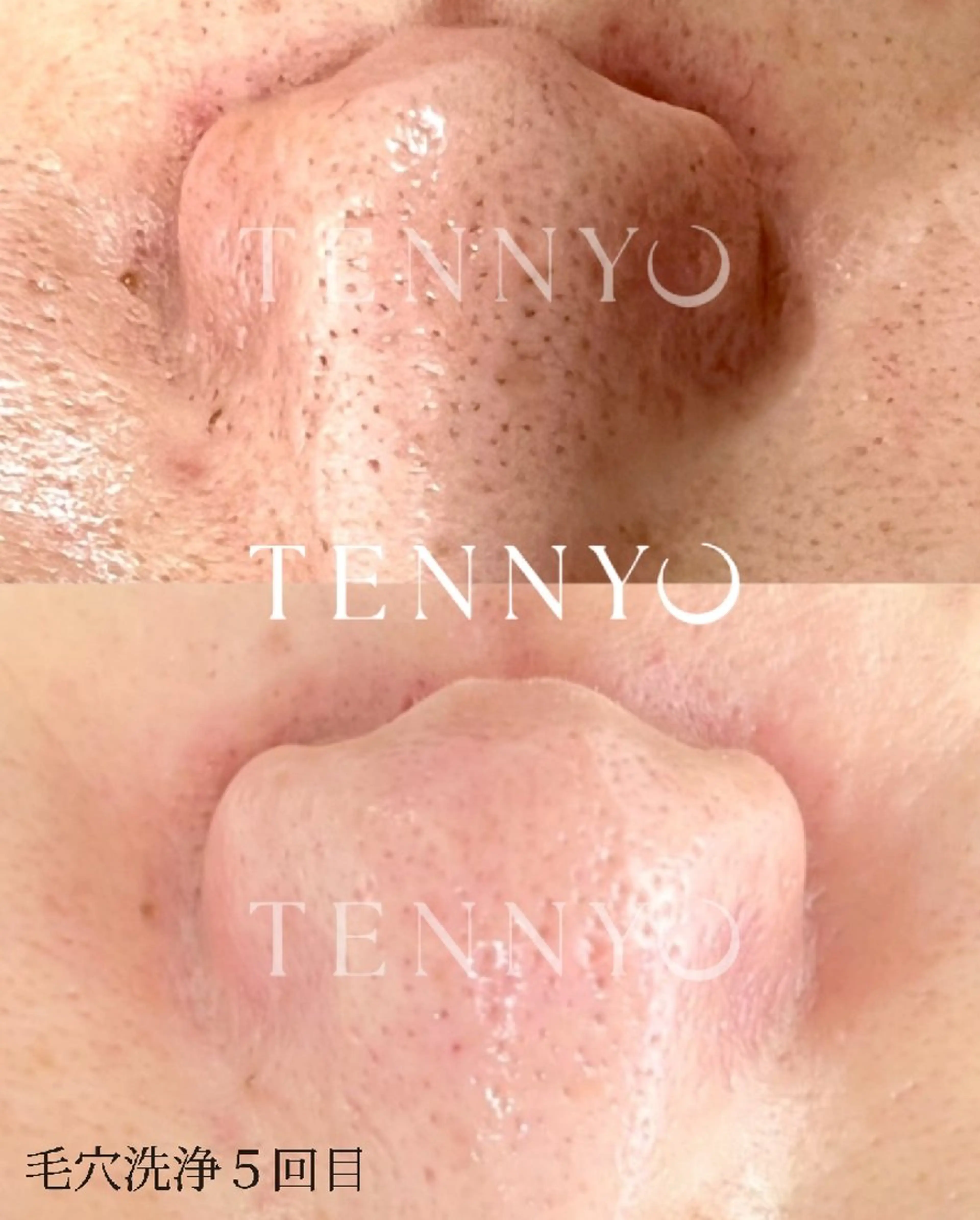 最新【毛穴洗浄モニター様】頑固な角栓や皮脂に！肌負担なしだからこそキレイなお肌へ導きます✨️敏感肌対応！の写真