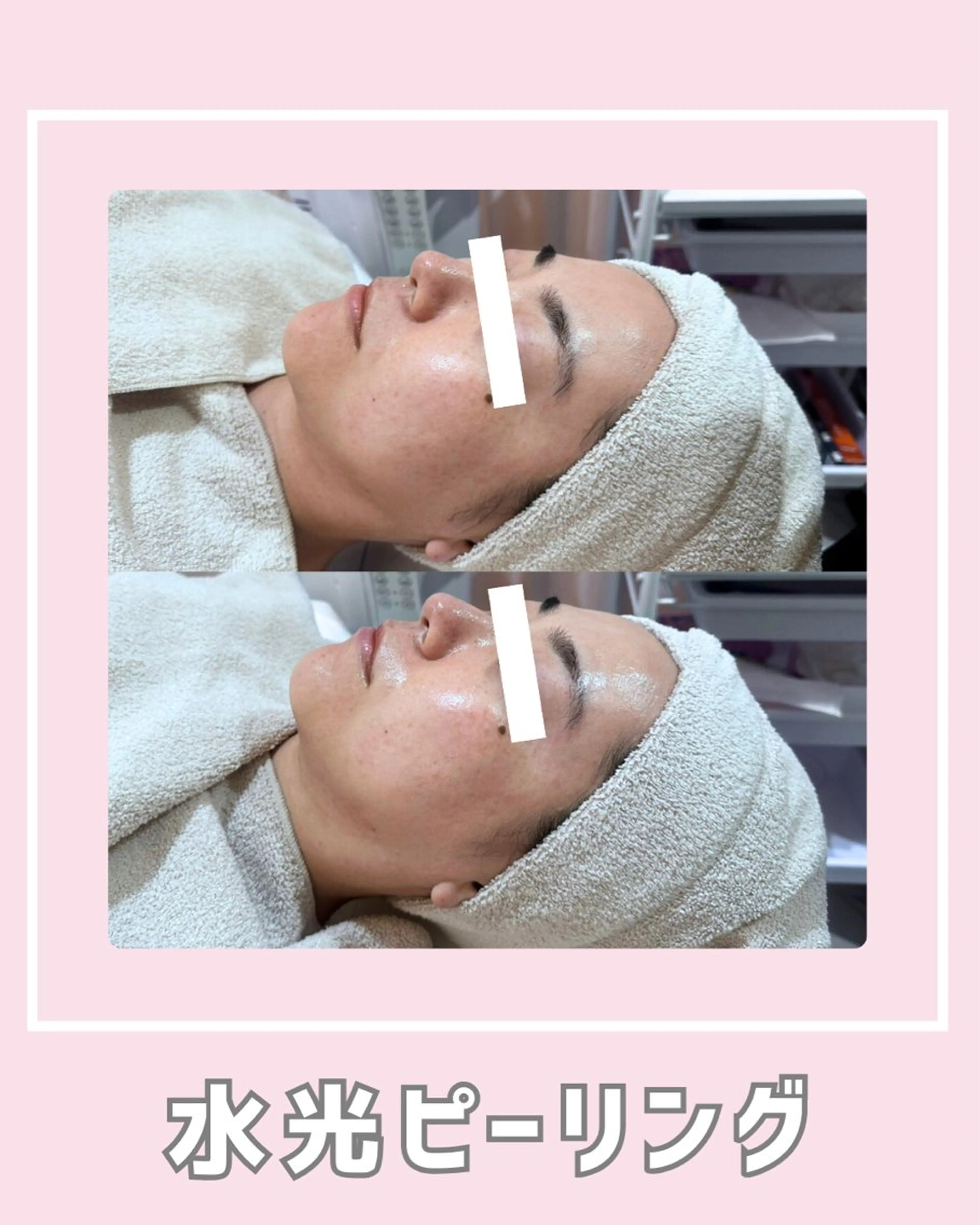 エステ |ピーリング・毛穴| soina神楽坂のエステ・リラクイメージ