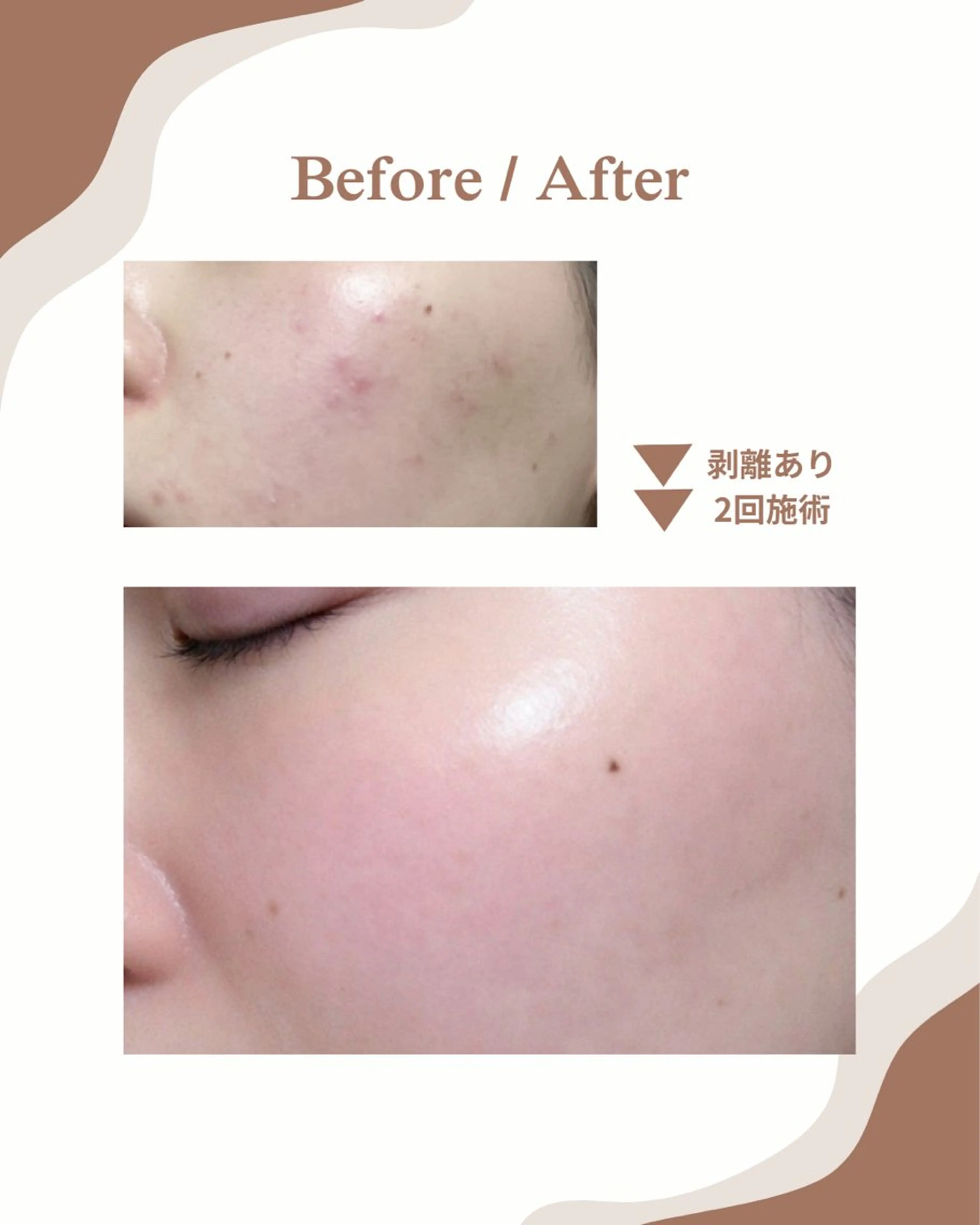 エステ myherb所属・ニキビ肌改善サロン myherb🌿のエステ・リラクイメージ