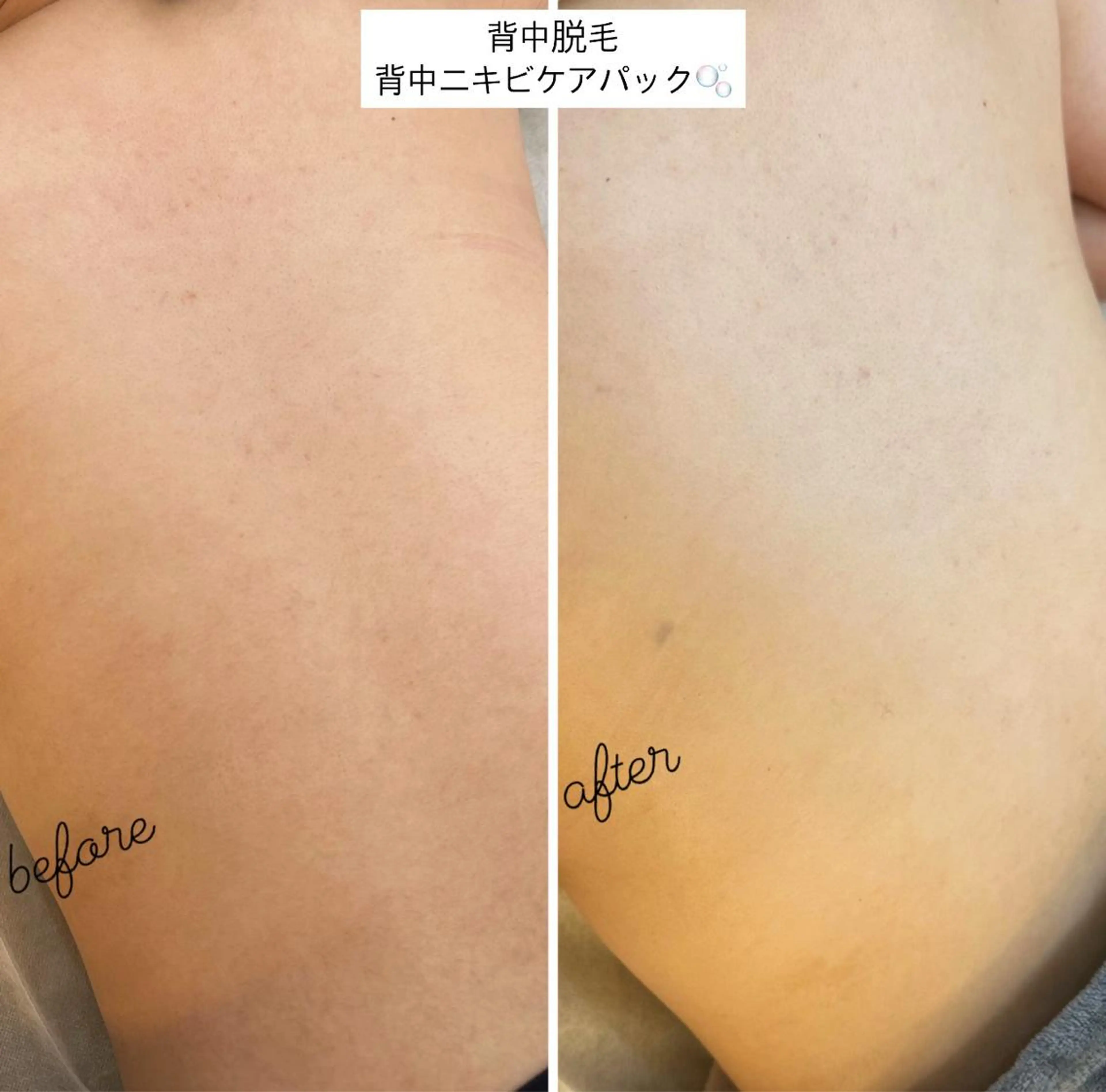 うなじ脱毛/美肌脱毛 LABELのエステ・リラクイメージ