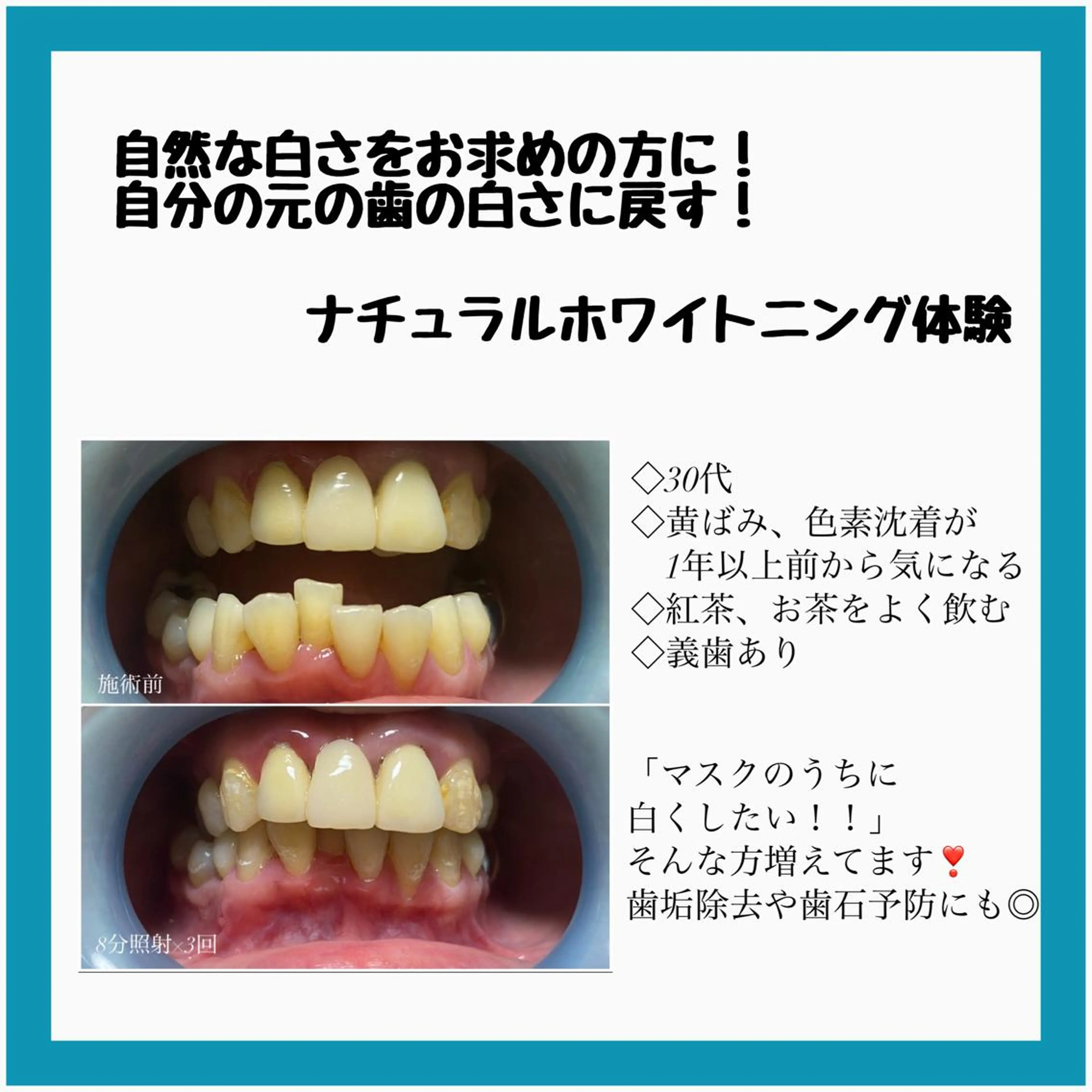 ネイル/耳つぼ /新ホワイトニングのネイルデザイン
