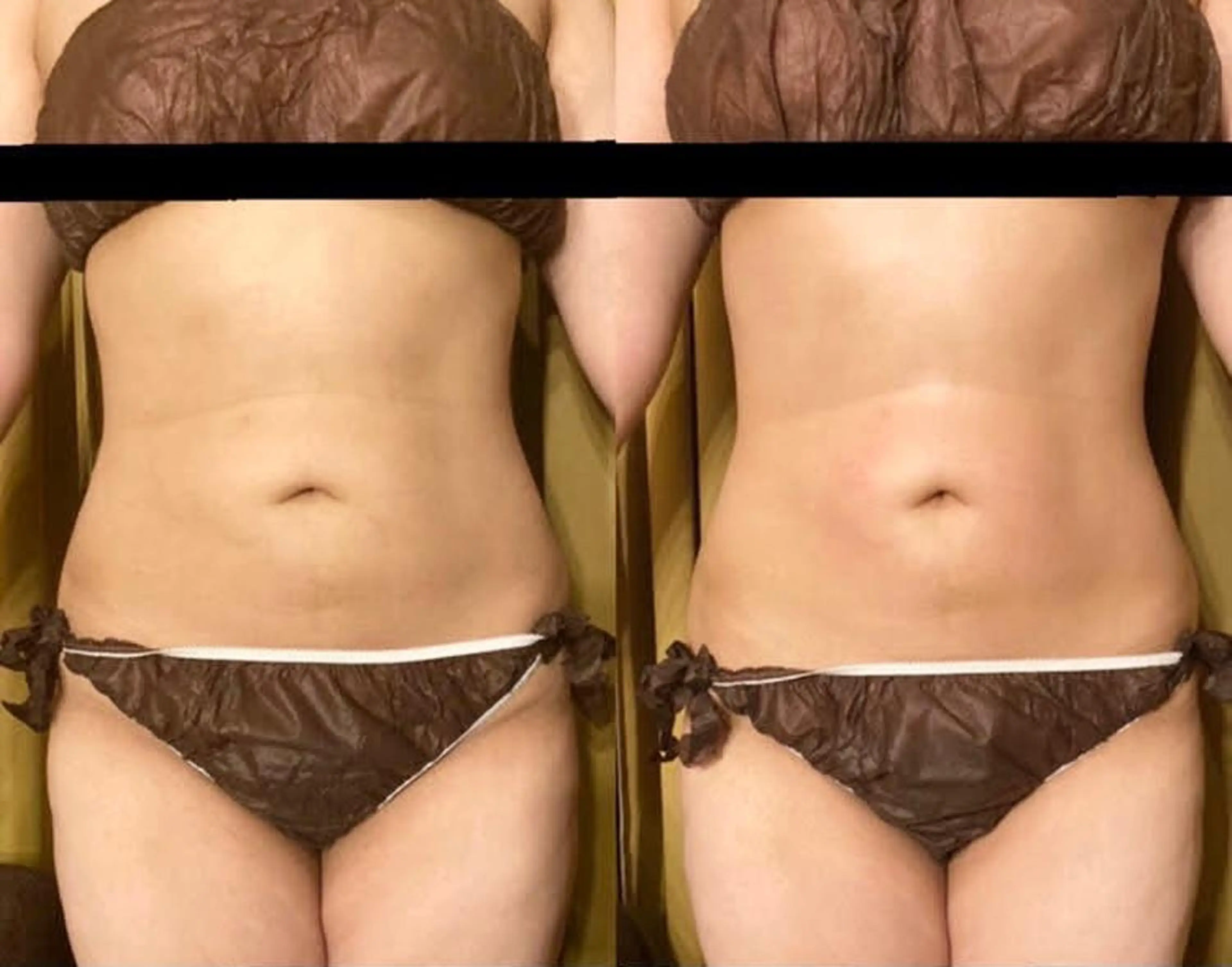 【痩身】当店人気No.1マシン🏅サーモシェイプDeep60分🔥スッキリ美Bodyへの写真