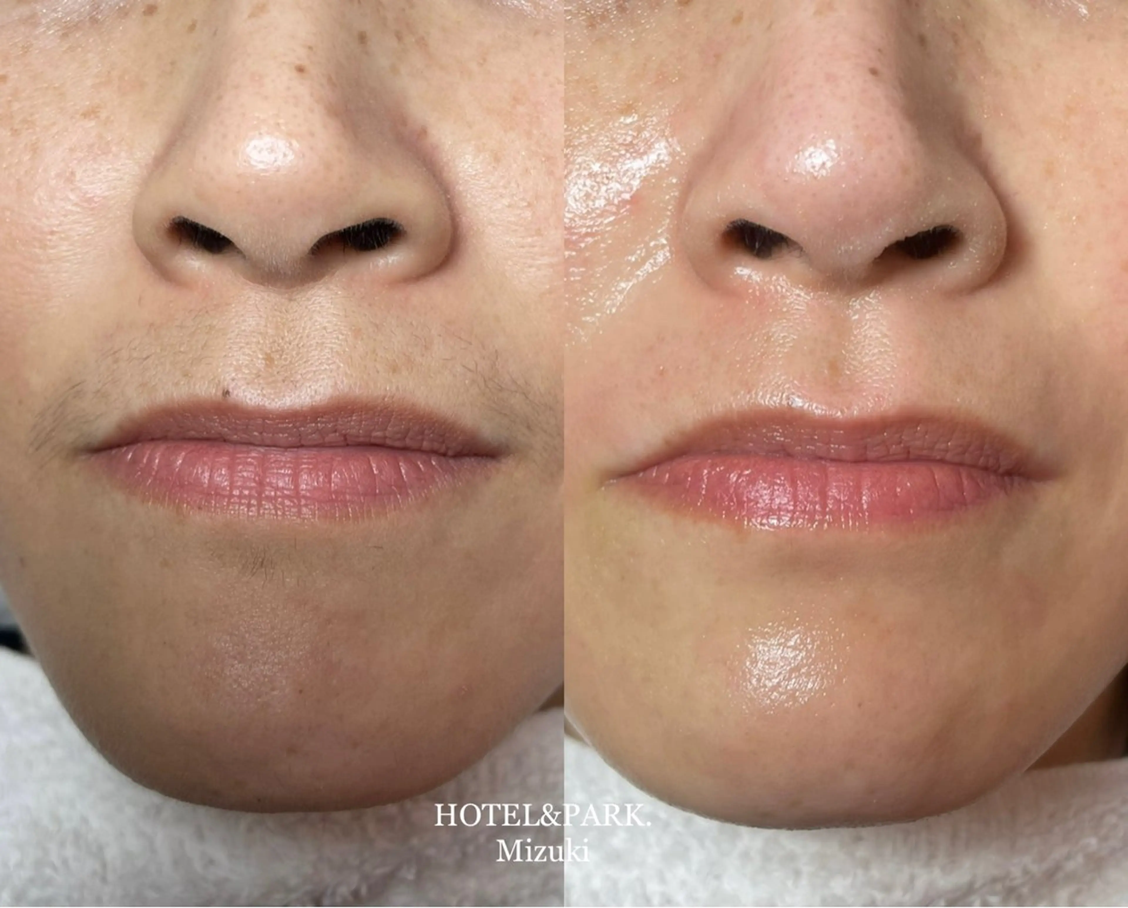 【お顔ALLワックス脱毛】*眉デザイン込の写真