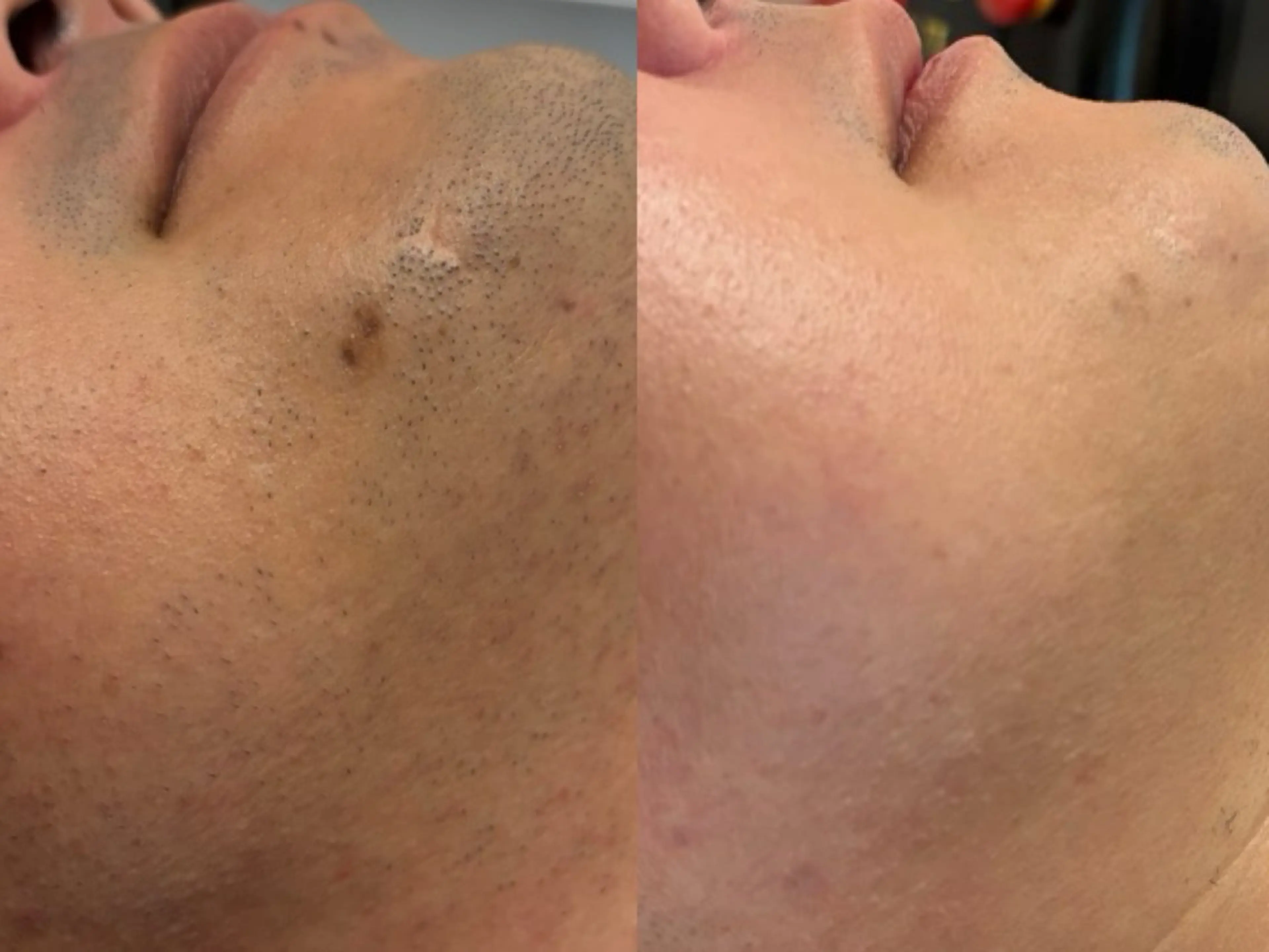 【メンズ髭脱毛】 REVI美肌脱毛の写真