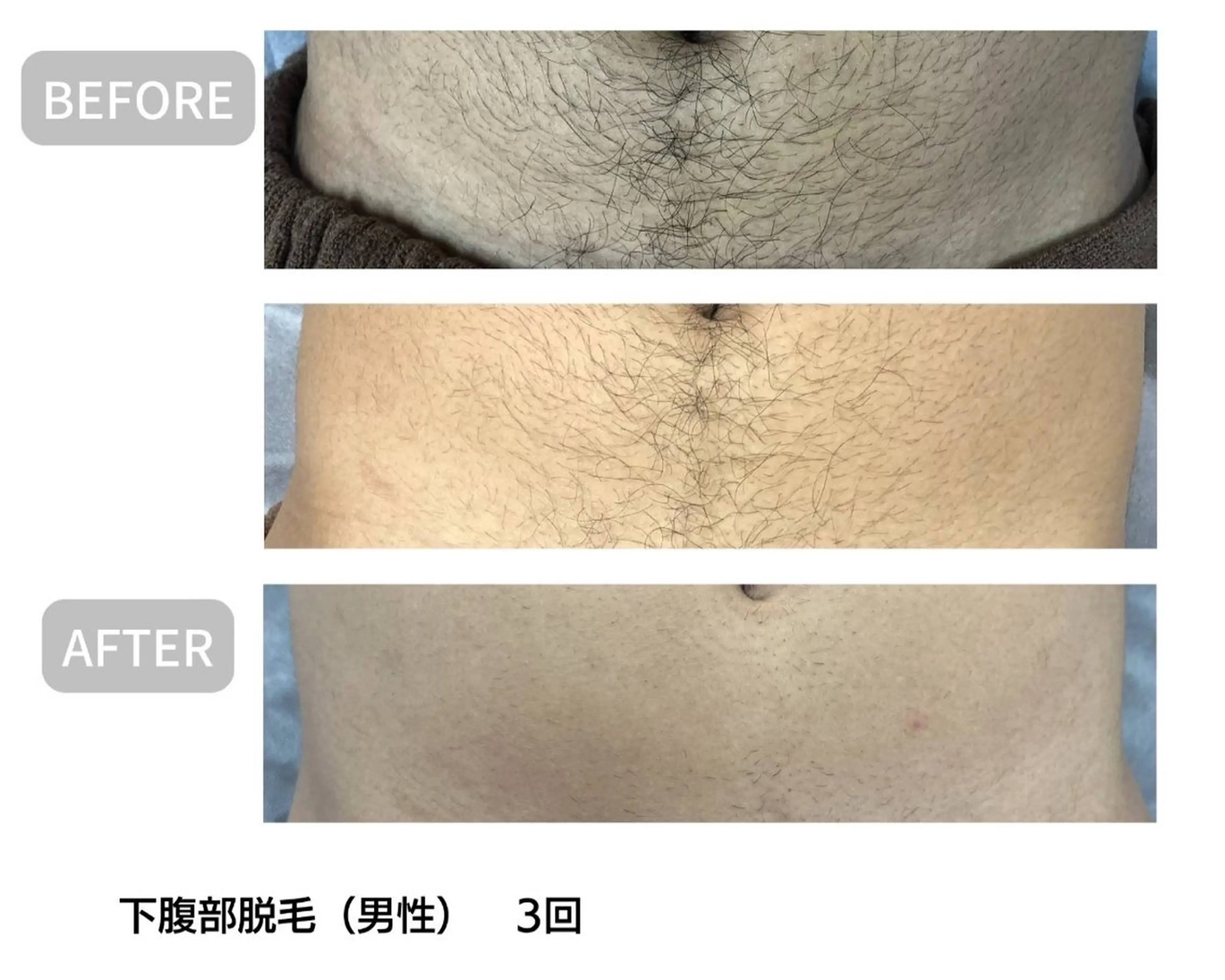 高速美肌脱毛ー 🌸女性🌸	肘下or ひざ下orお腹（男性は＋1,100円)の写真